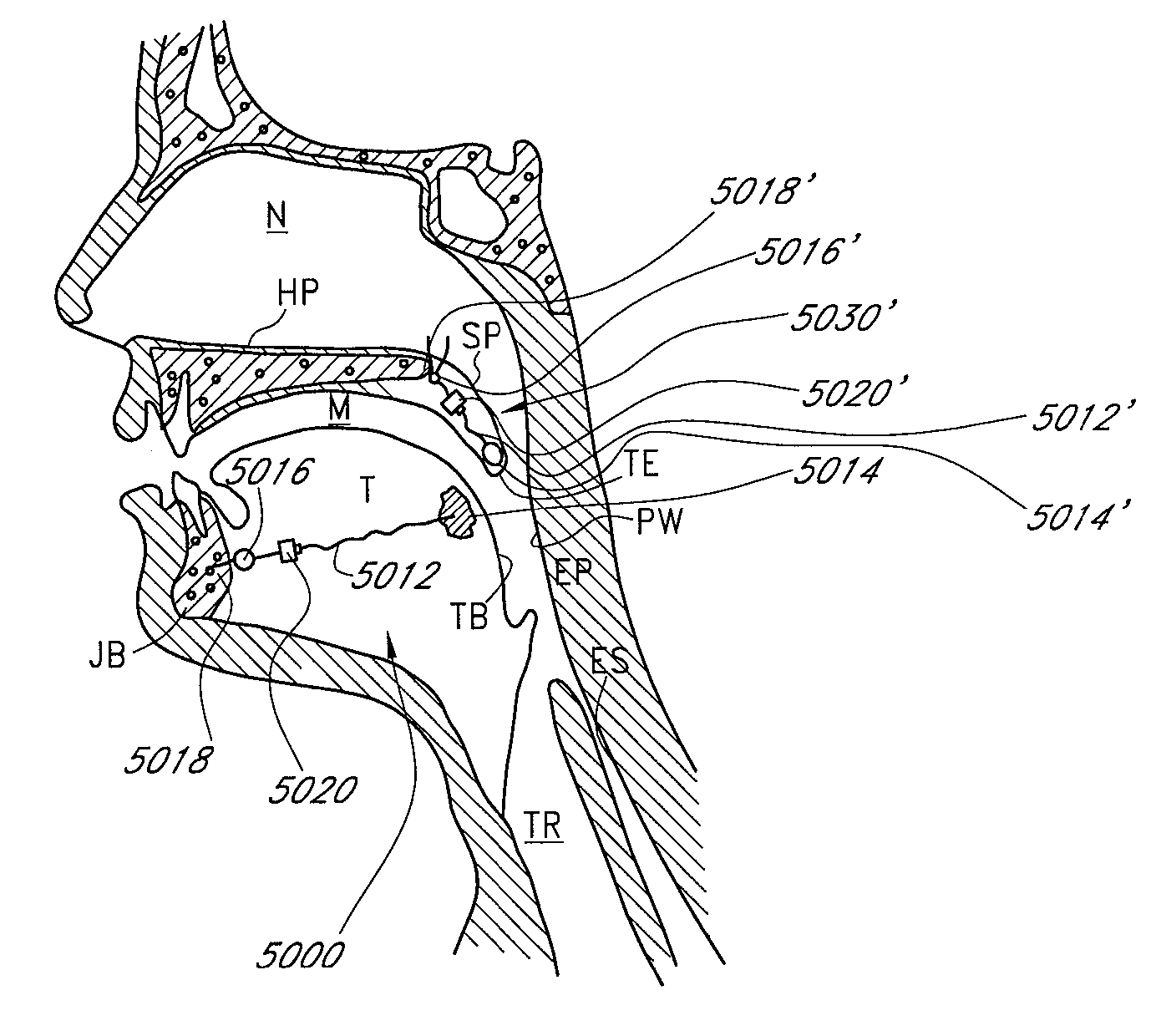 Airway implants and methods and devices for insertion and retrieval