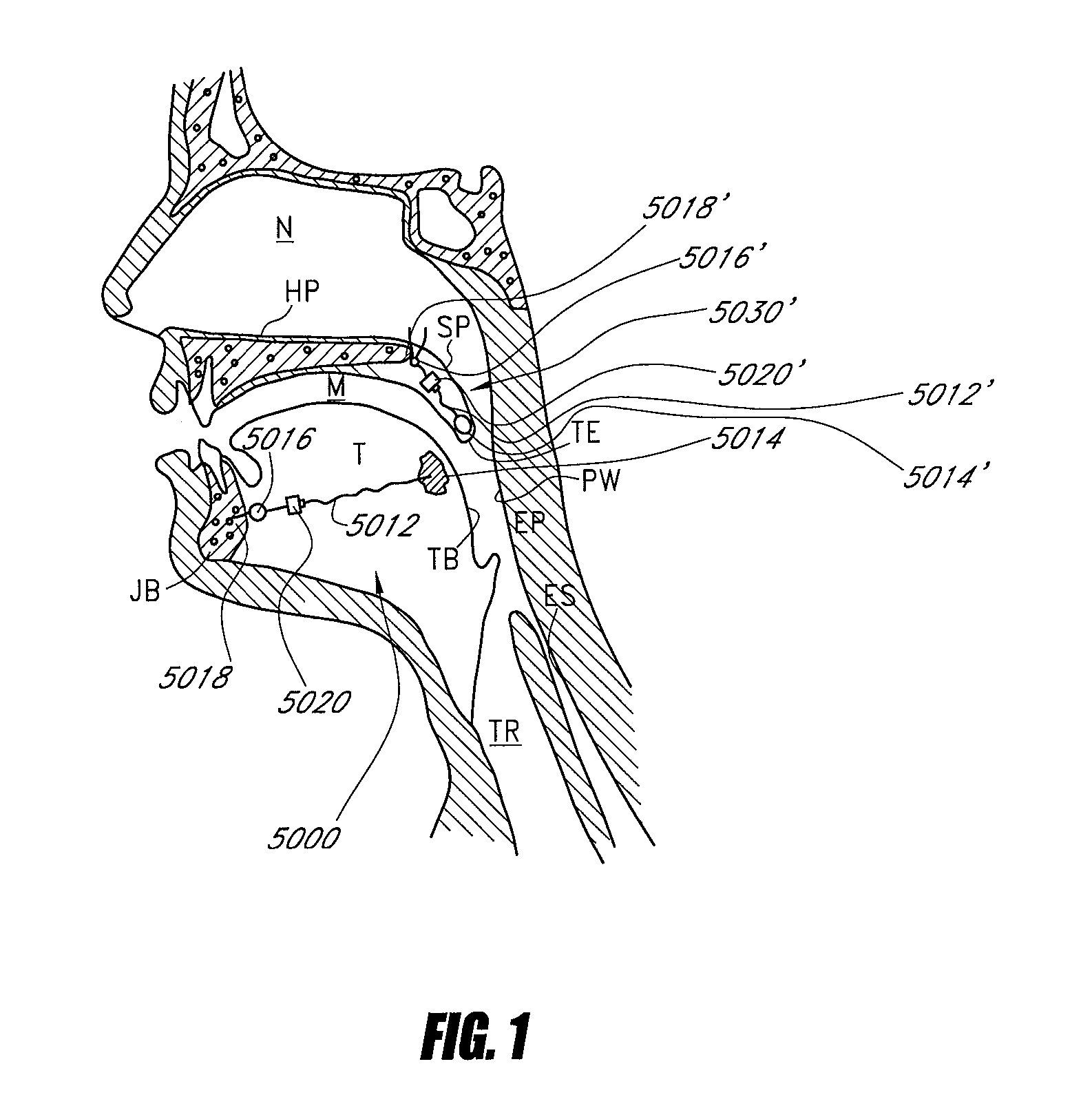 Airway implants and methods and devices for insertion and retrieval