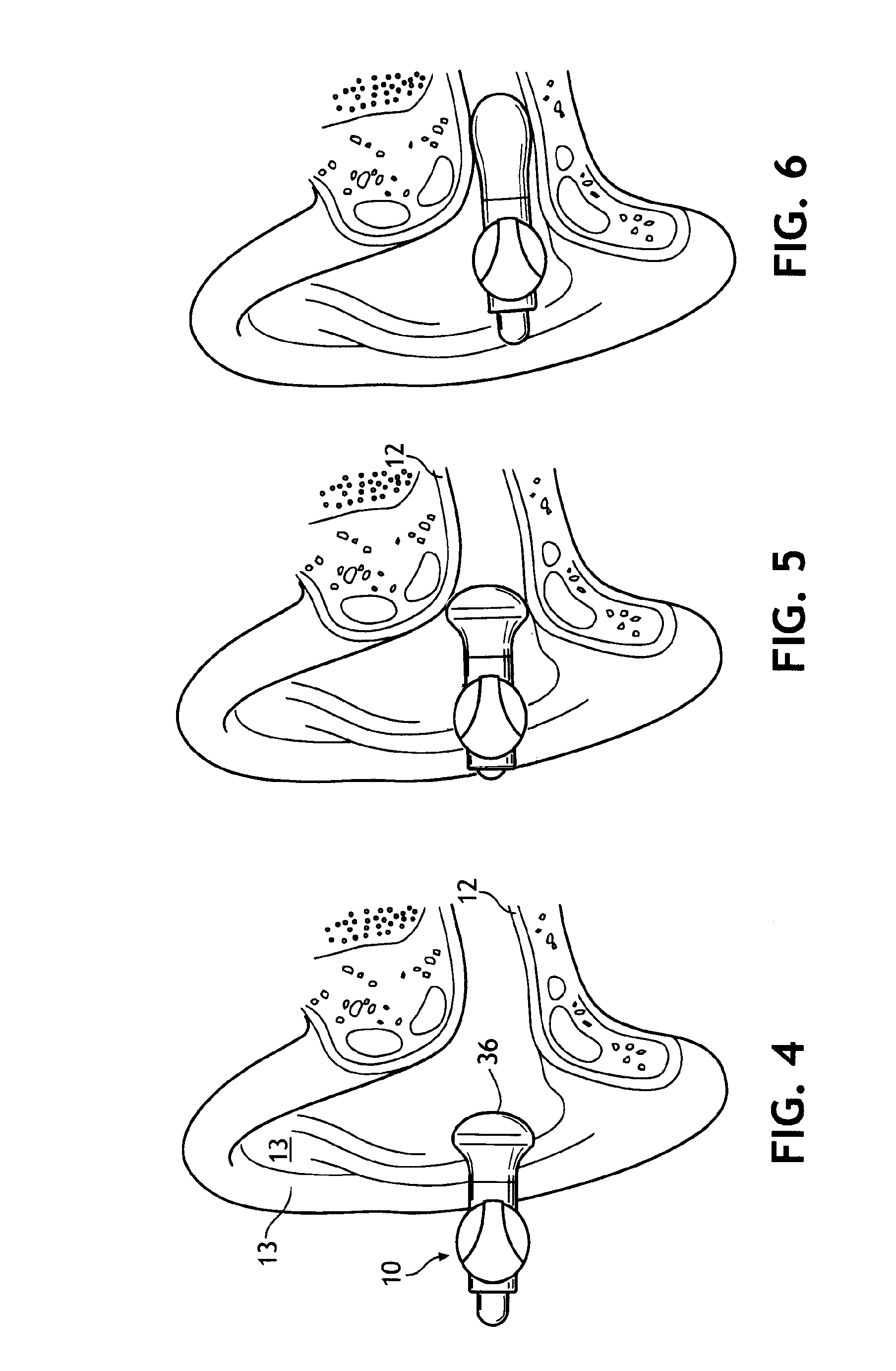 Self-fitting device for location in an ear canal