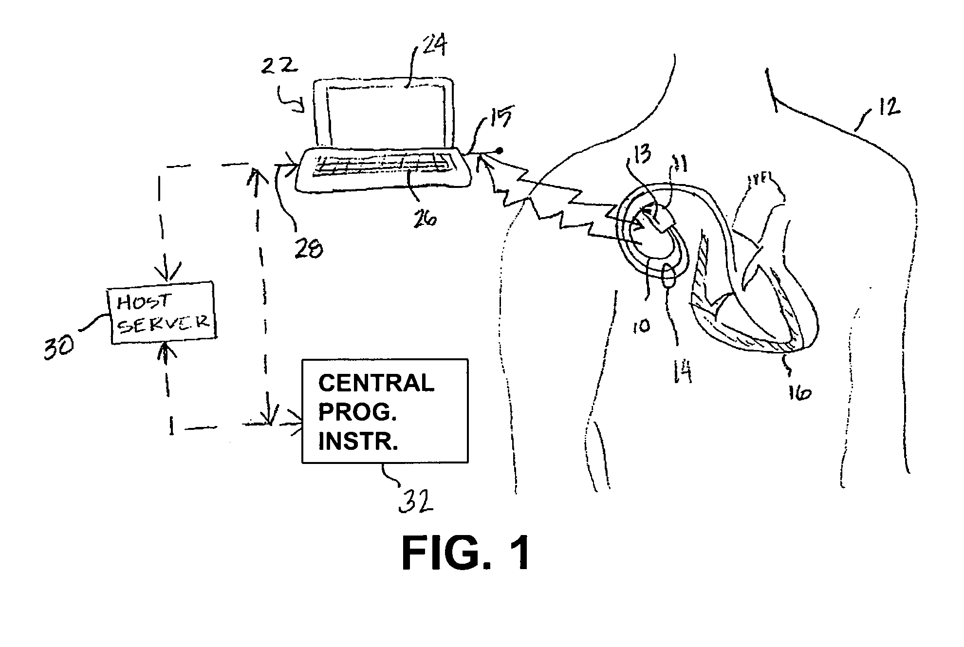 Remote programming of implantable medical devices