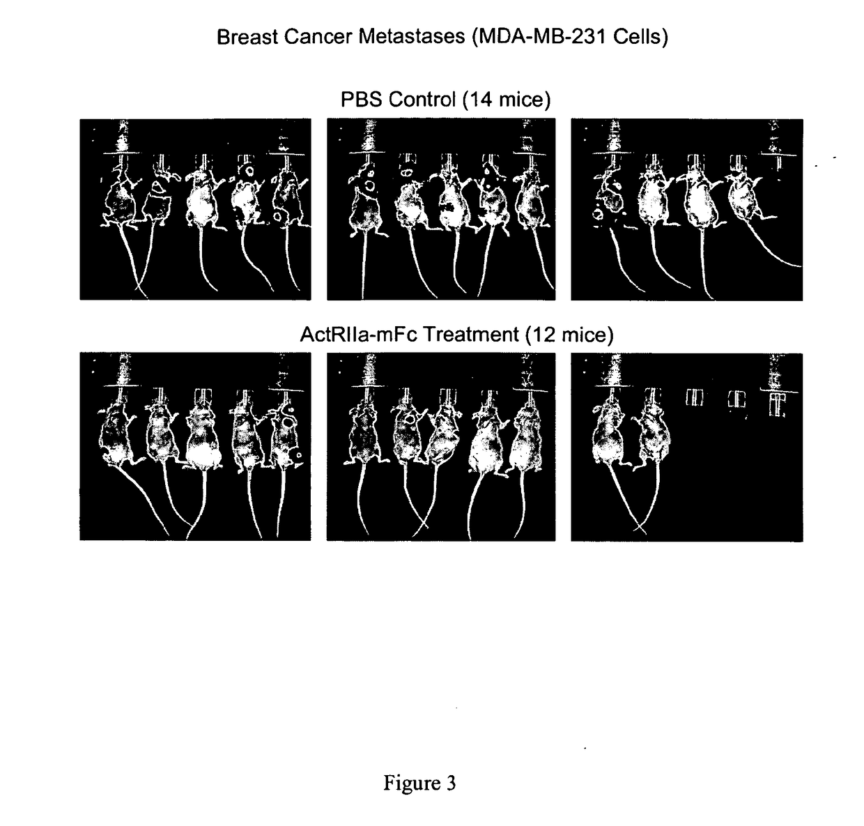 Activin-actriia antagonists and uses for treating or preventing breast cancer