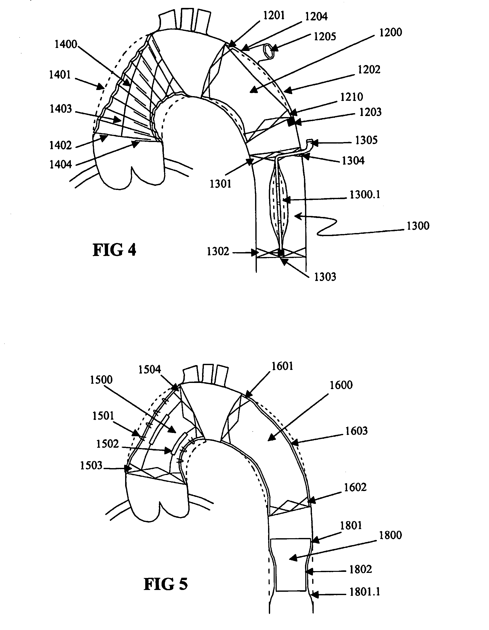 Vessel or sac wall treatment and a cardiac assist device