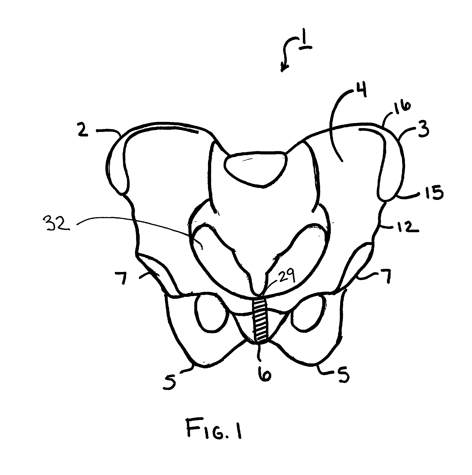 Innominate osteotomy