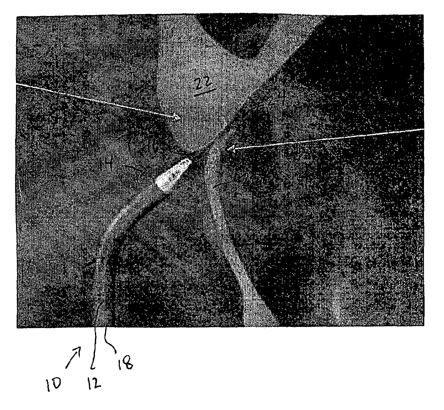 Method and apparatus for detecting and achieving closure of patent foramen ovale