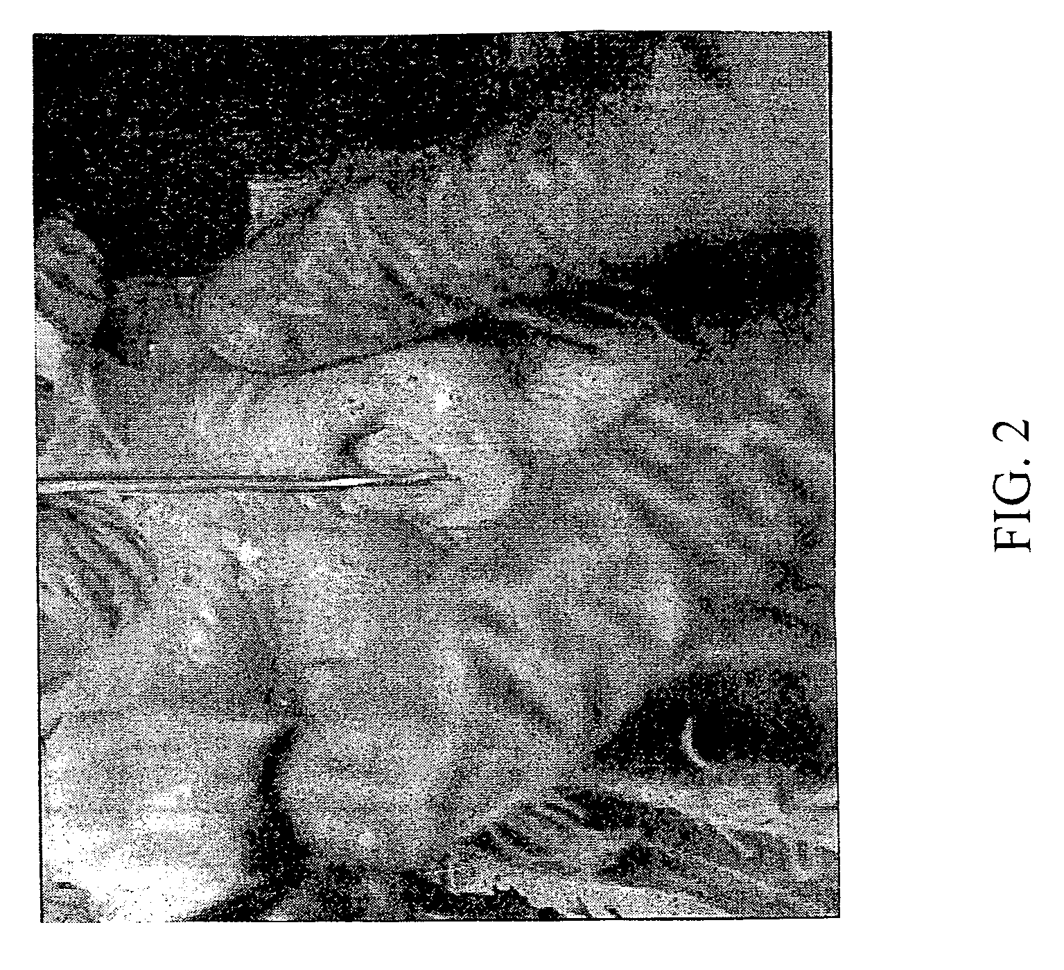 Method and apparatus for detecting and achieving closure of patent foramen ovale