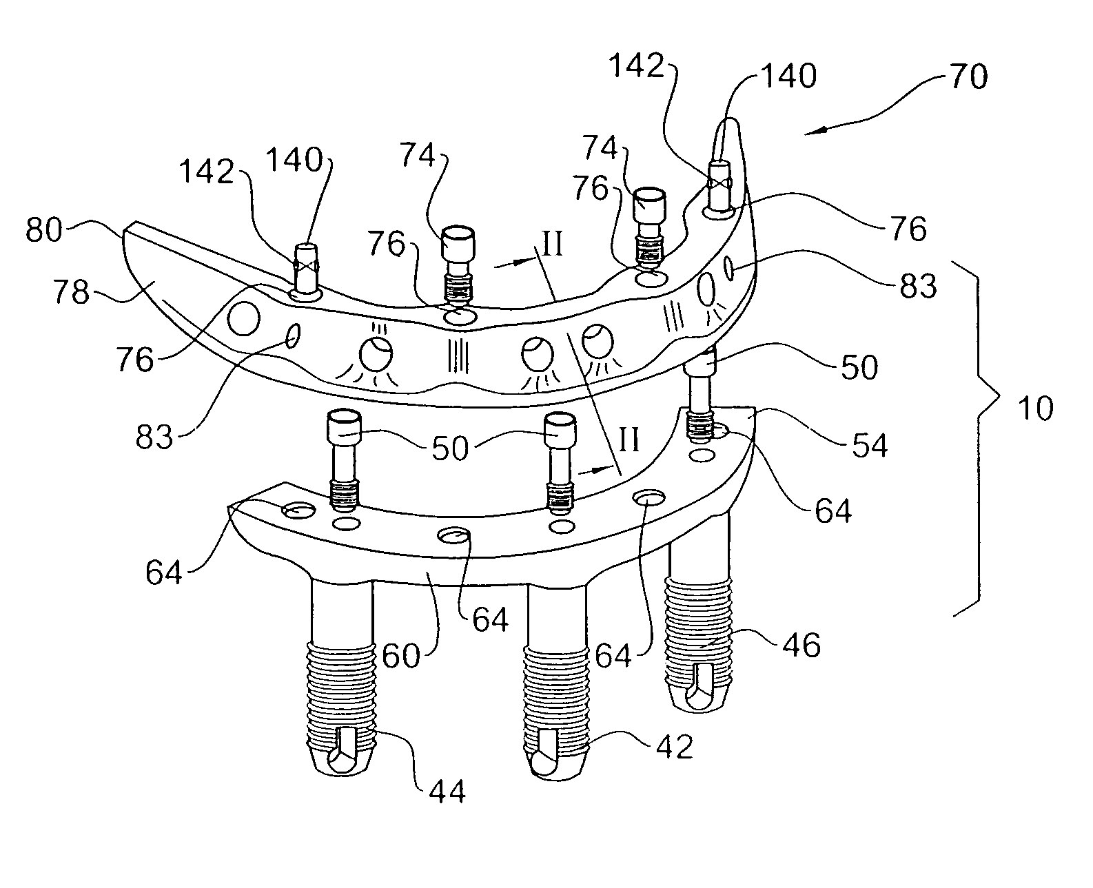 Method and system for fixing removable dentures