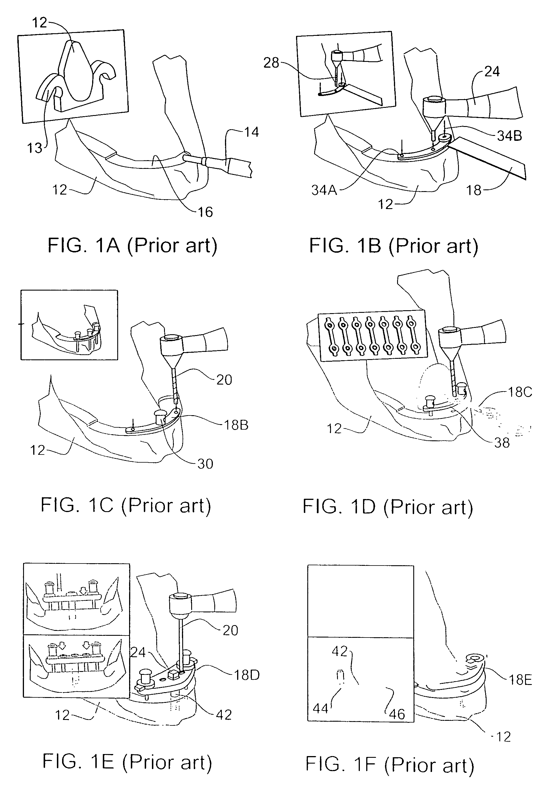 Method and system for fixing removable dentures