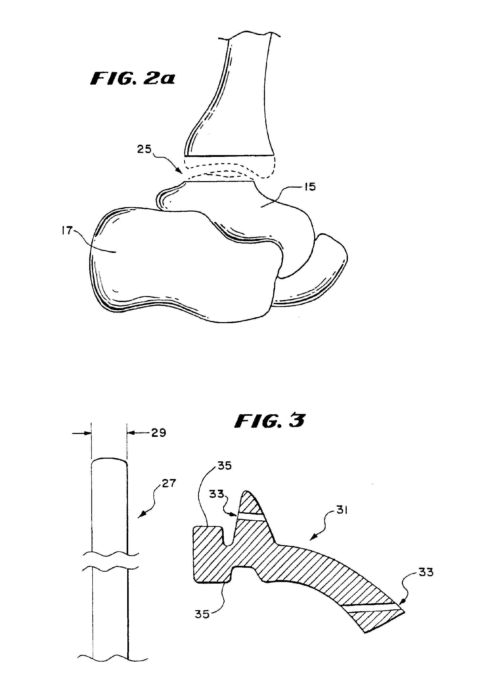 Intramedullary guidance systems and methods for installing ankle replacement prostheses