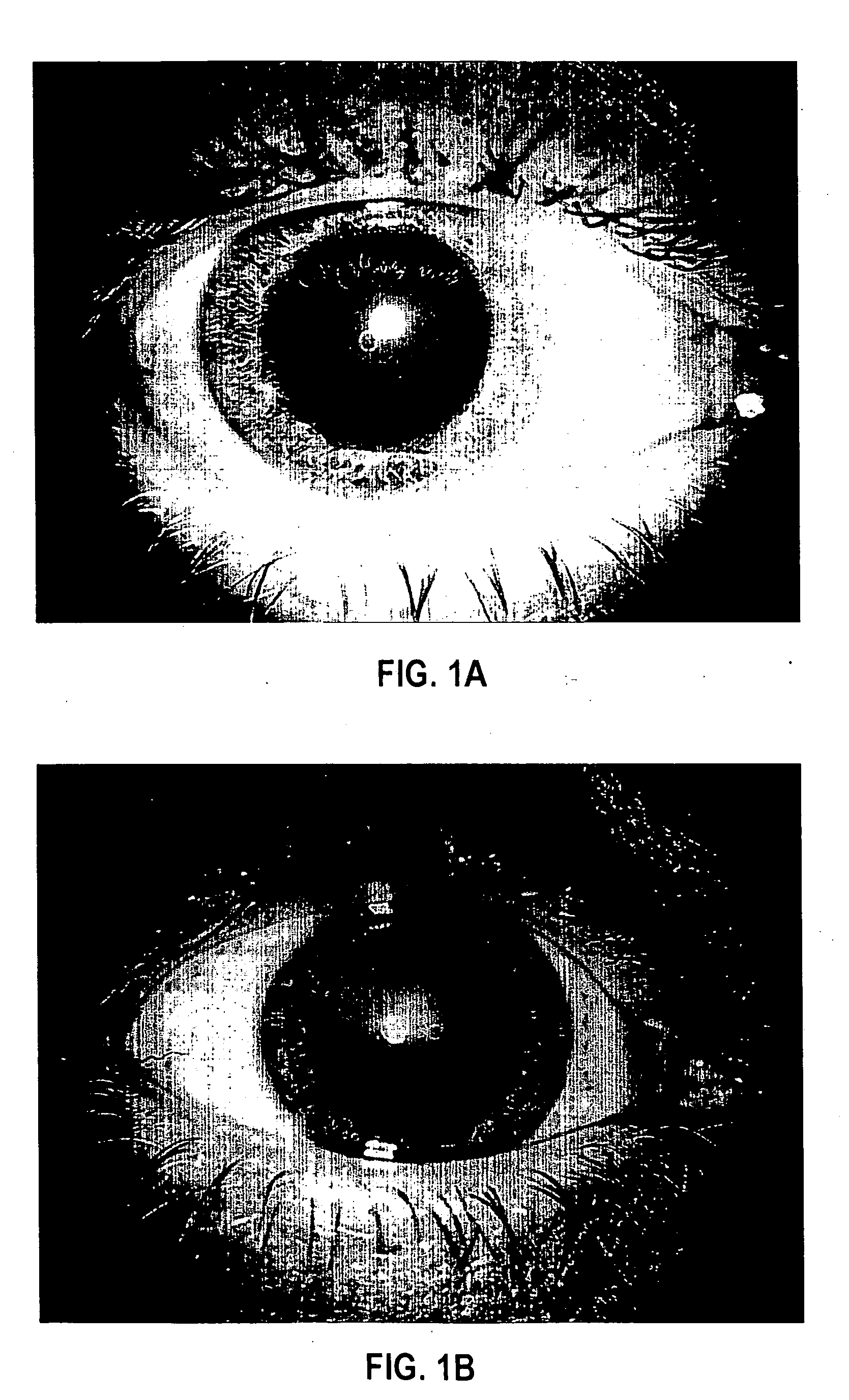 Treatment of conditions associated with the presence of macromolecular aggregates, particularly ophthalmic disorders