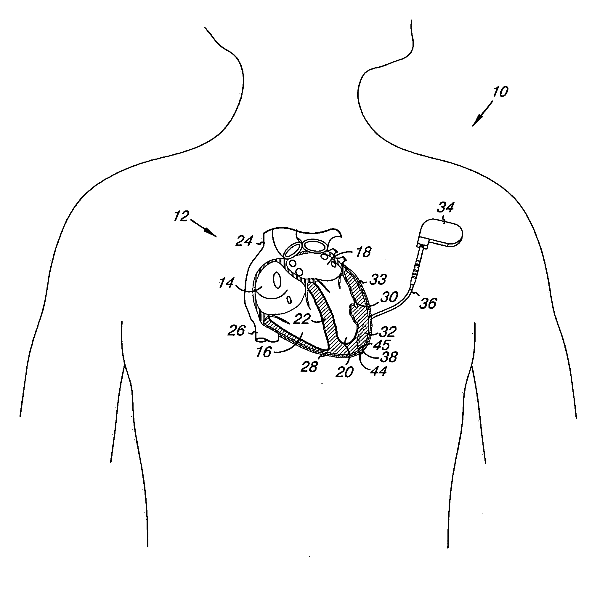 Absorbable myocardial lead fixation system