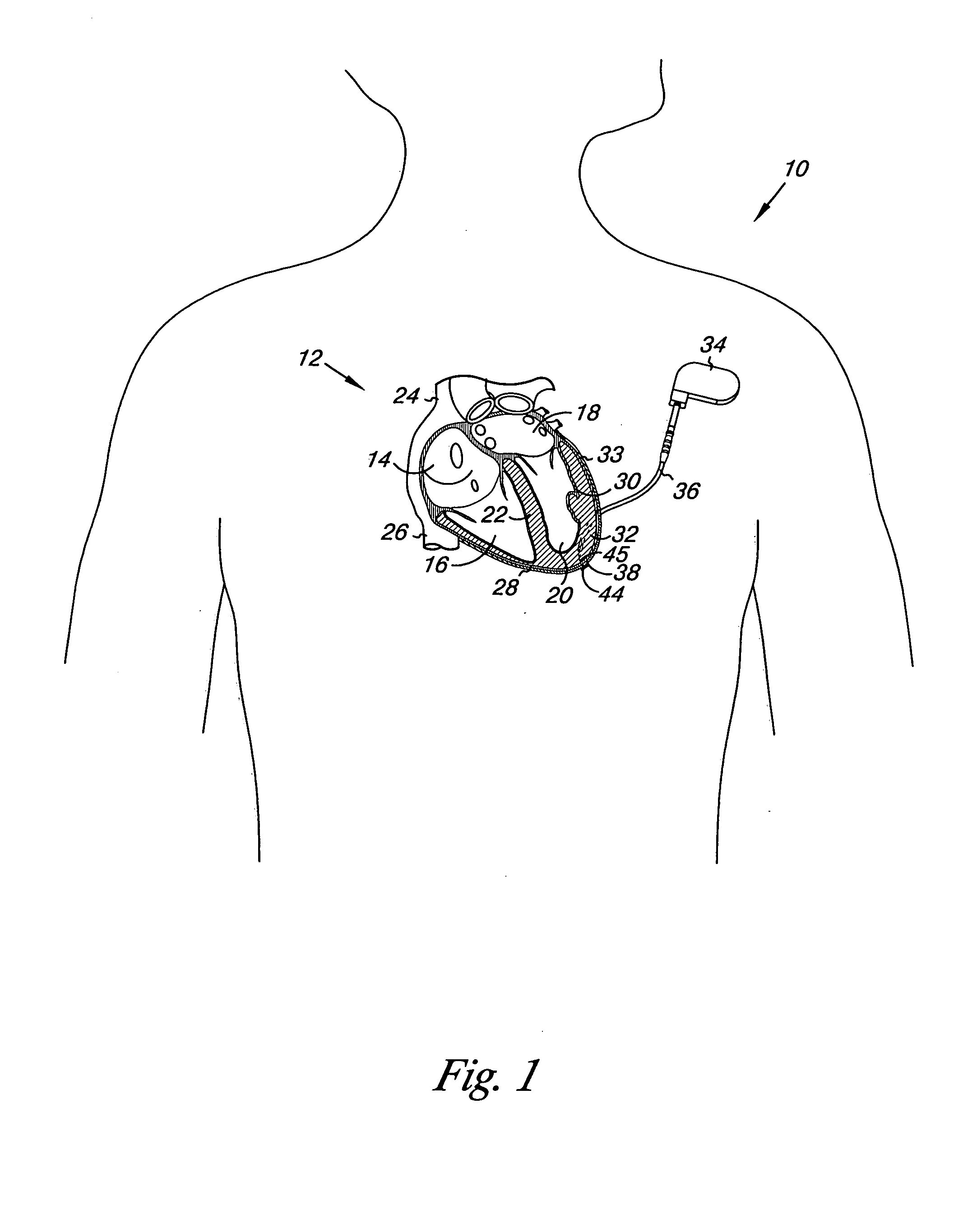 Absorbable myocardial lead fixation system