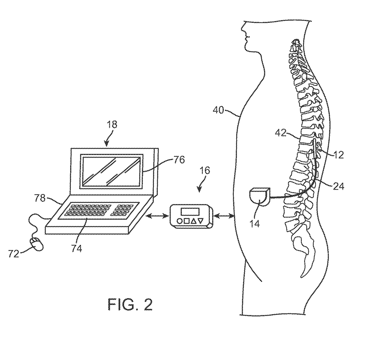 Neurostimulation system with flexible patterning and waveforms