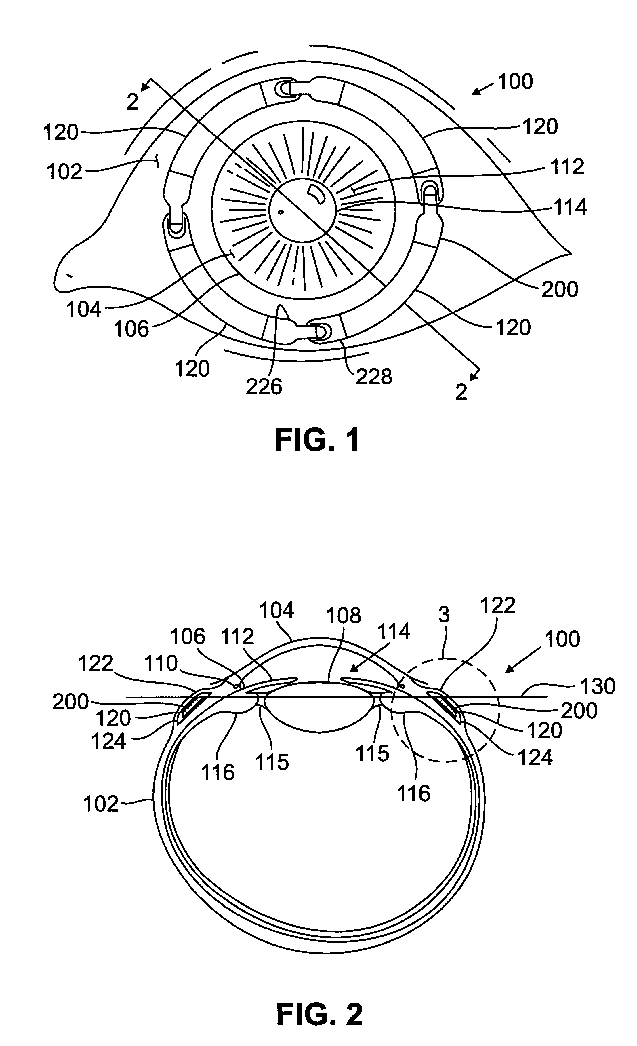 Segmented scleral band for treatment of presbyopia and other eye disorders