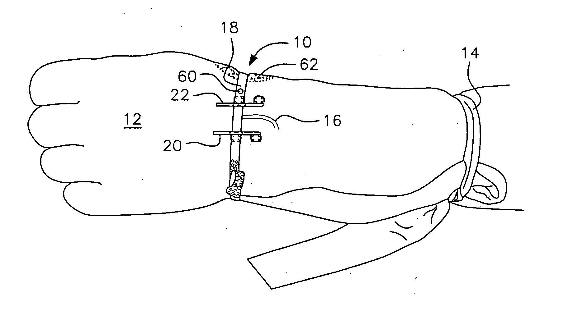 Vein Stabilizer