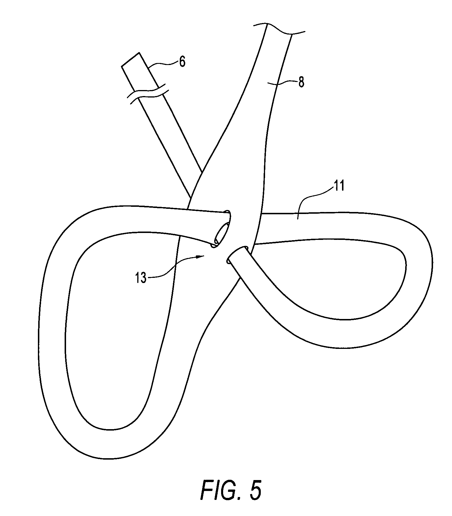 Looped high strength suture chain for knotless fixation