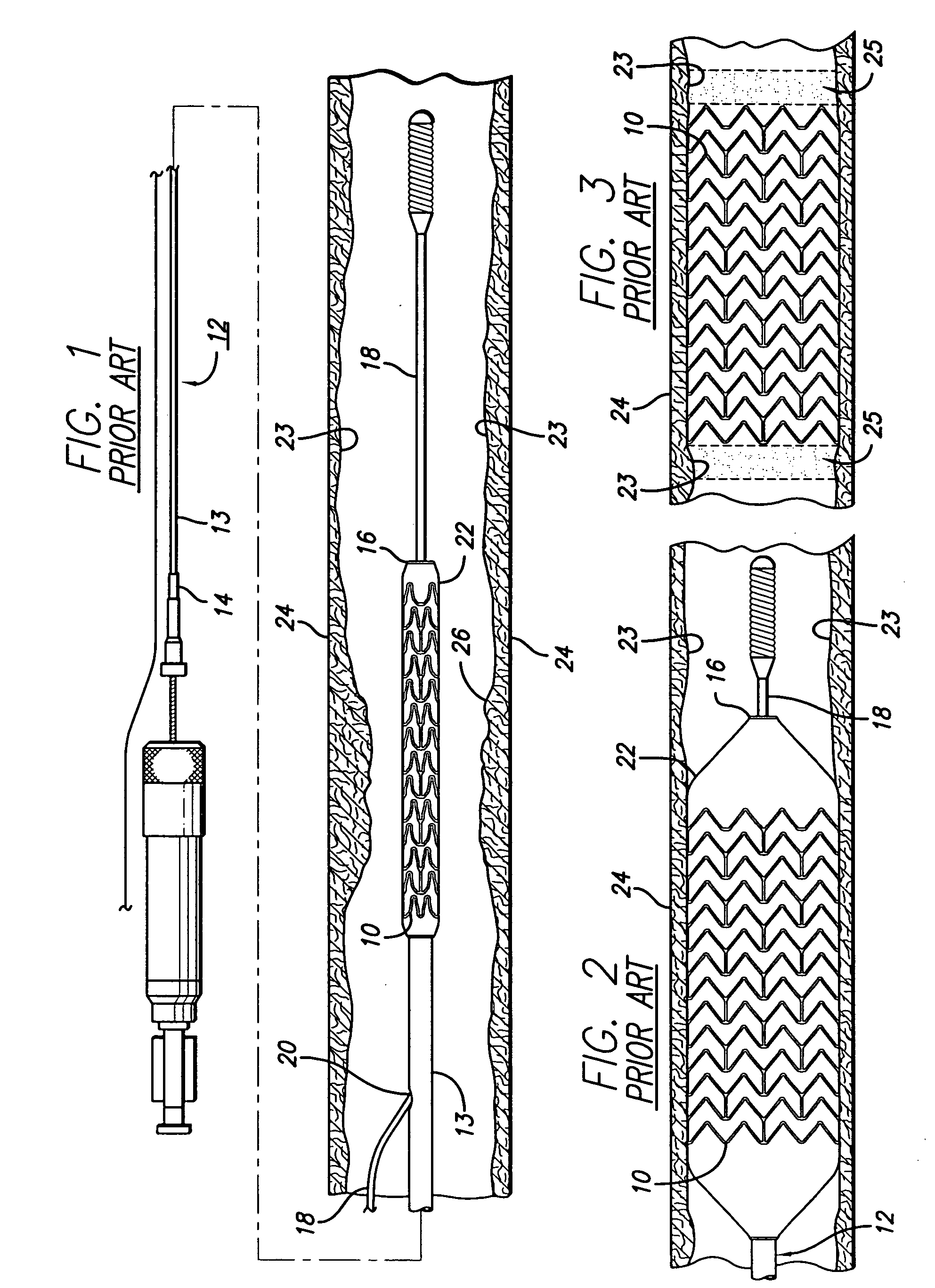 Intravascular stent with extendible end rings