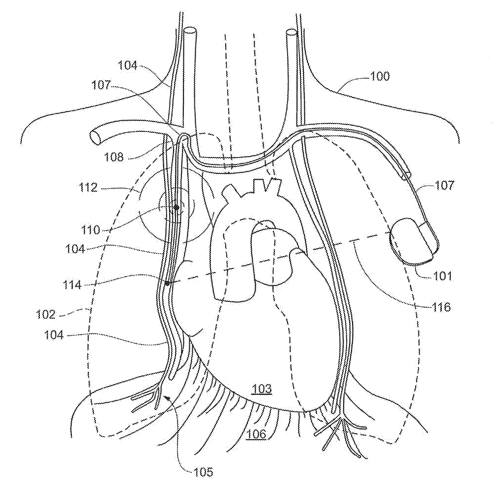 System and Method to Modulate Phrenic Nerve to Prevent Sleep Apnea