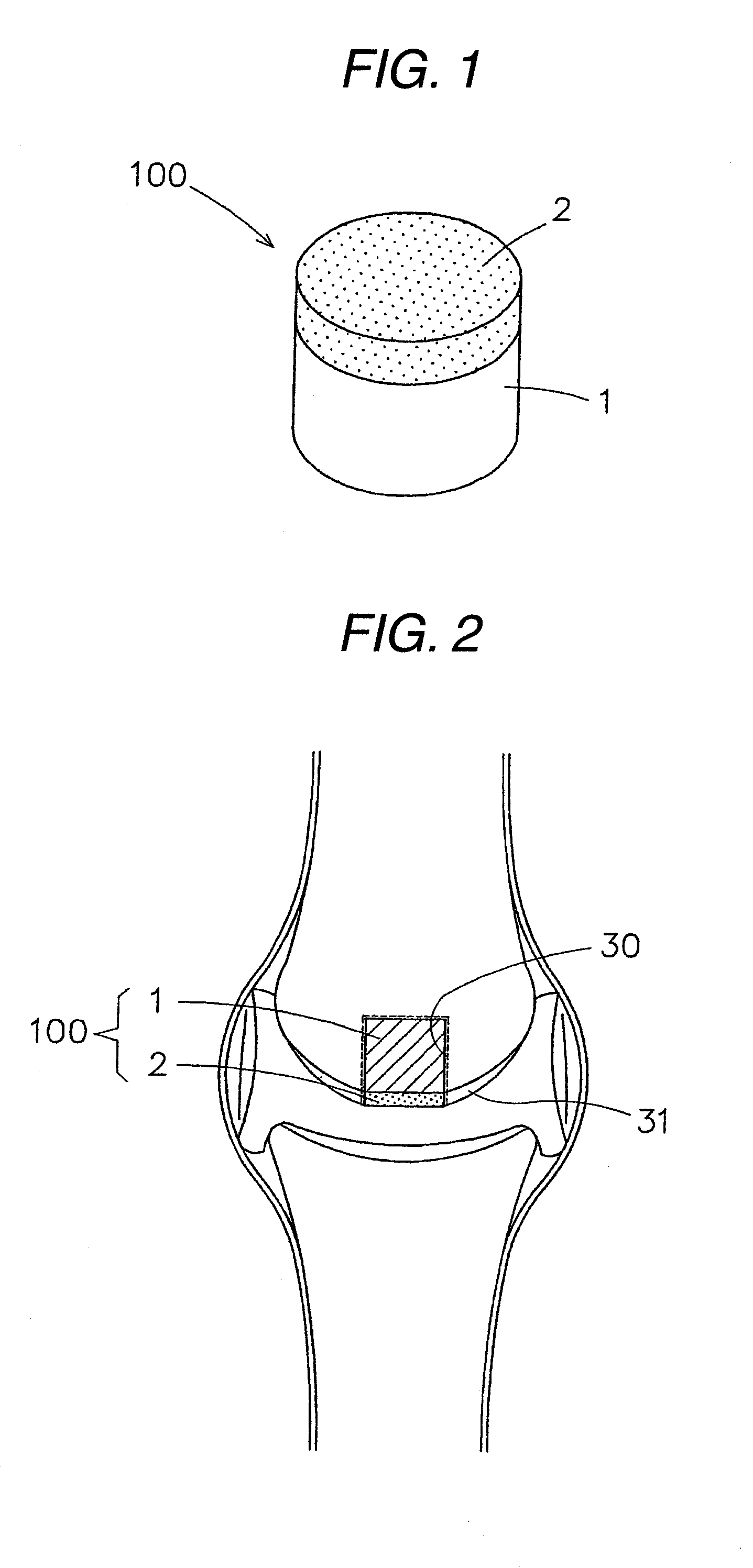 Implant composite material