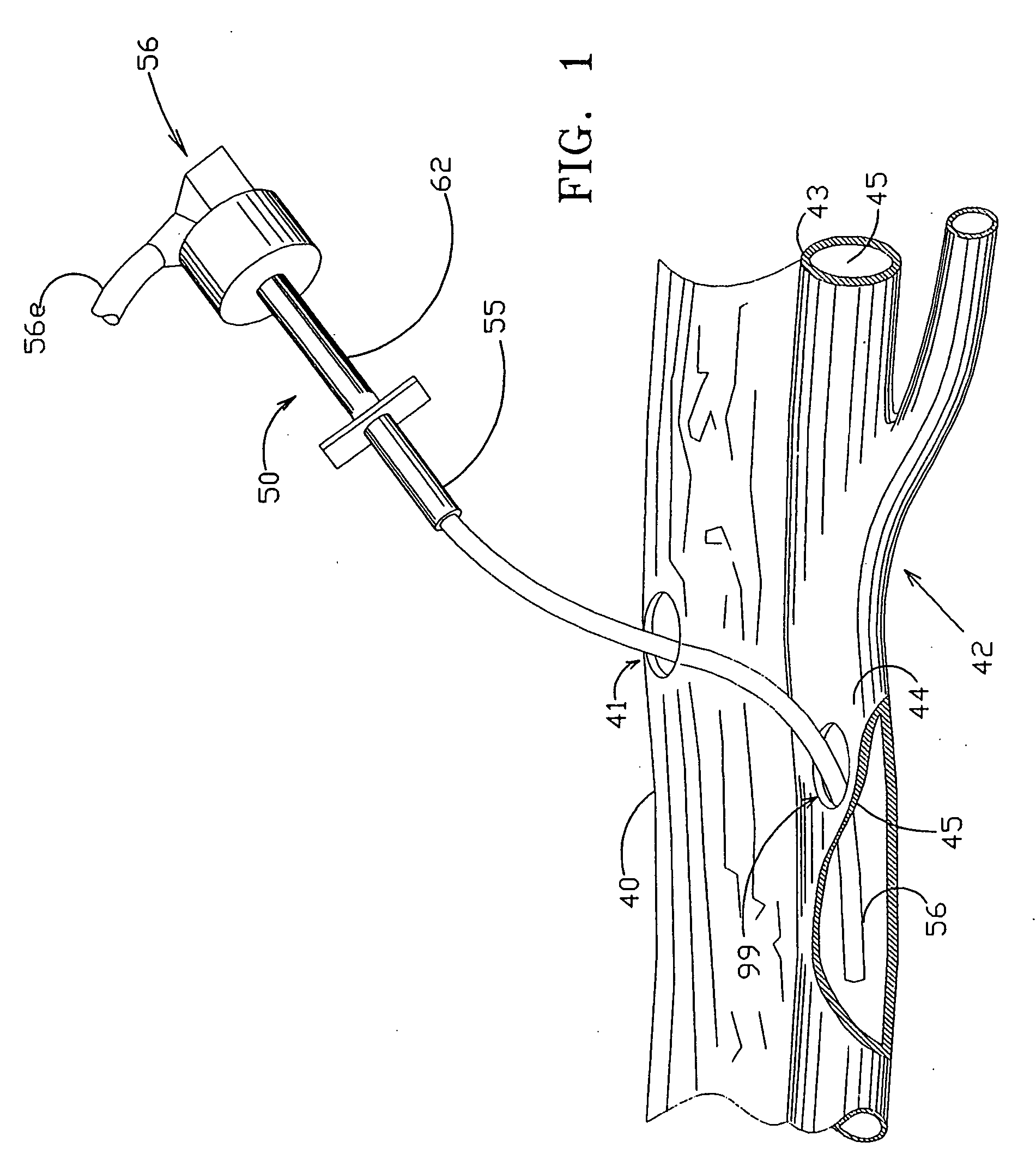 Apparatus and method for positive closure of an internal tissue membrane opening