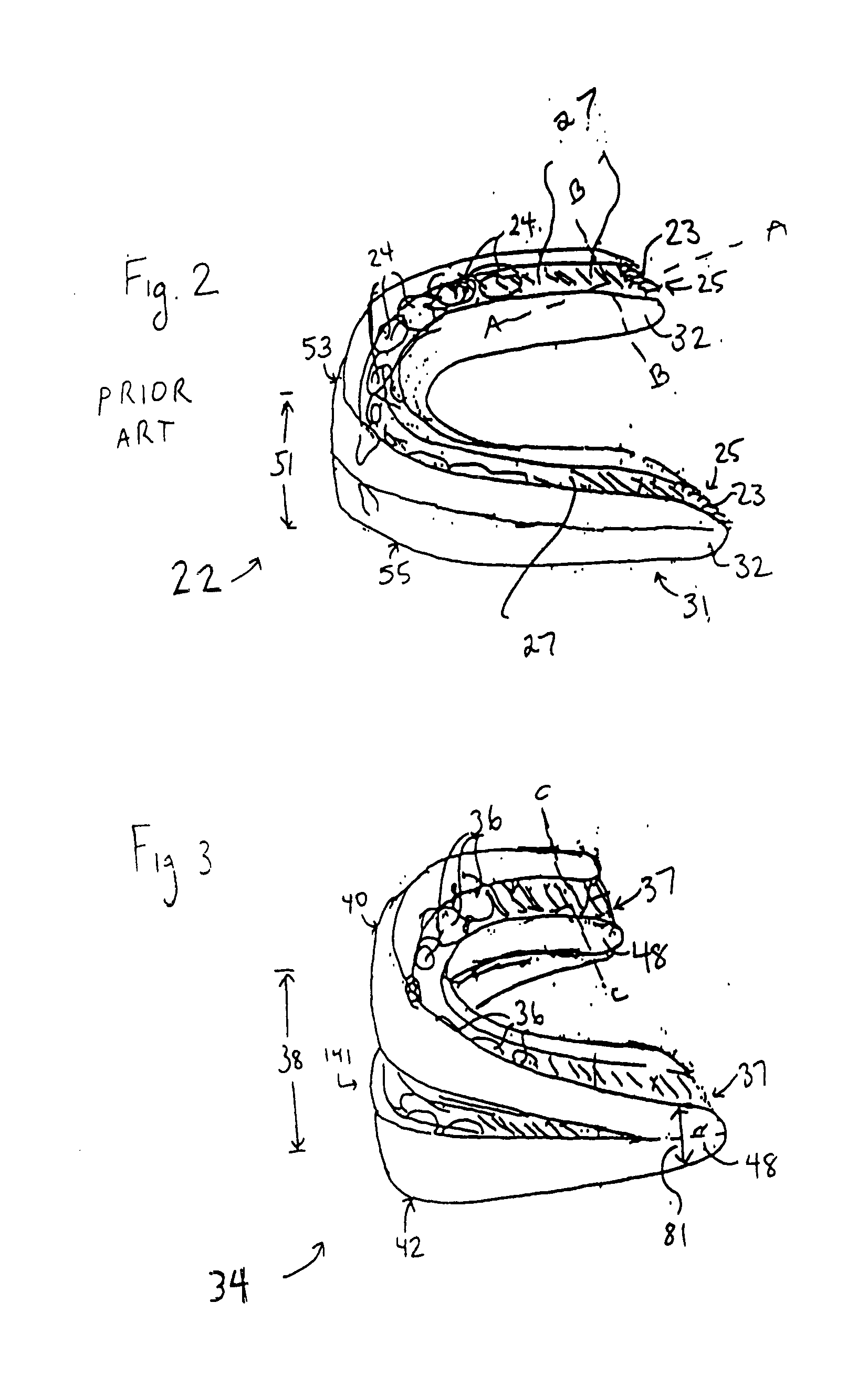 Dental appliance having an altered vertical thickness between an upper shell and a lower shell with an integrated hinging mechanism to attach an upper shell and a lower shell and a system and a method for treating malocclusions