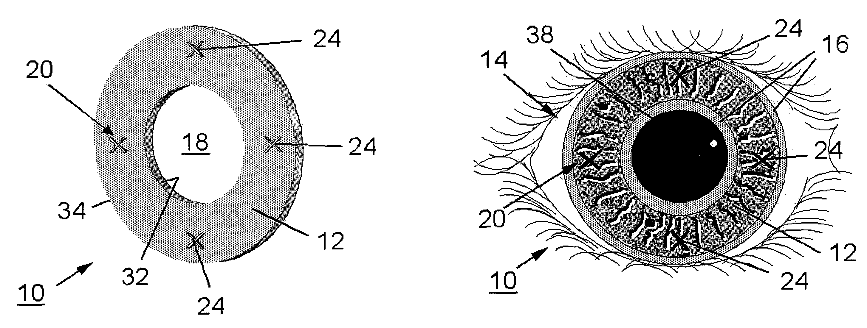 Implant for altering the iris color and method of locating and fixing an implant for altering the iris color