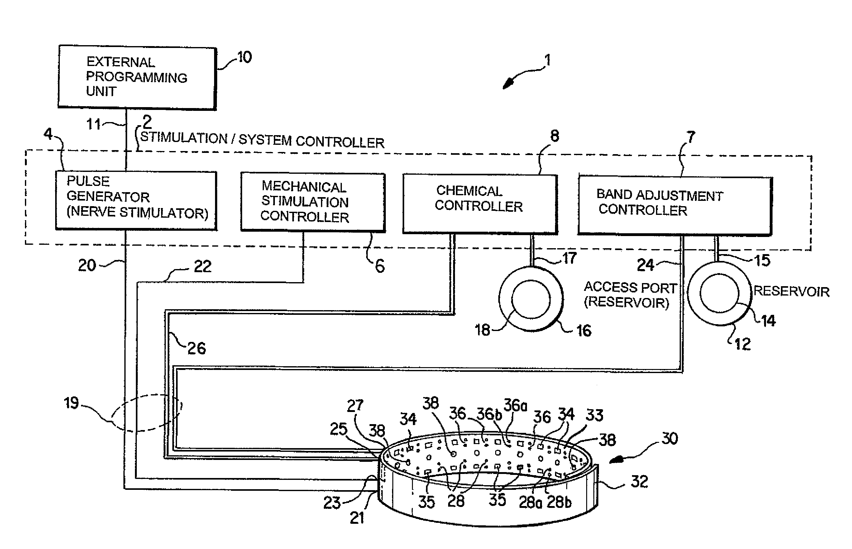 Noninvasively adjustable gastric band