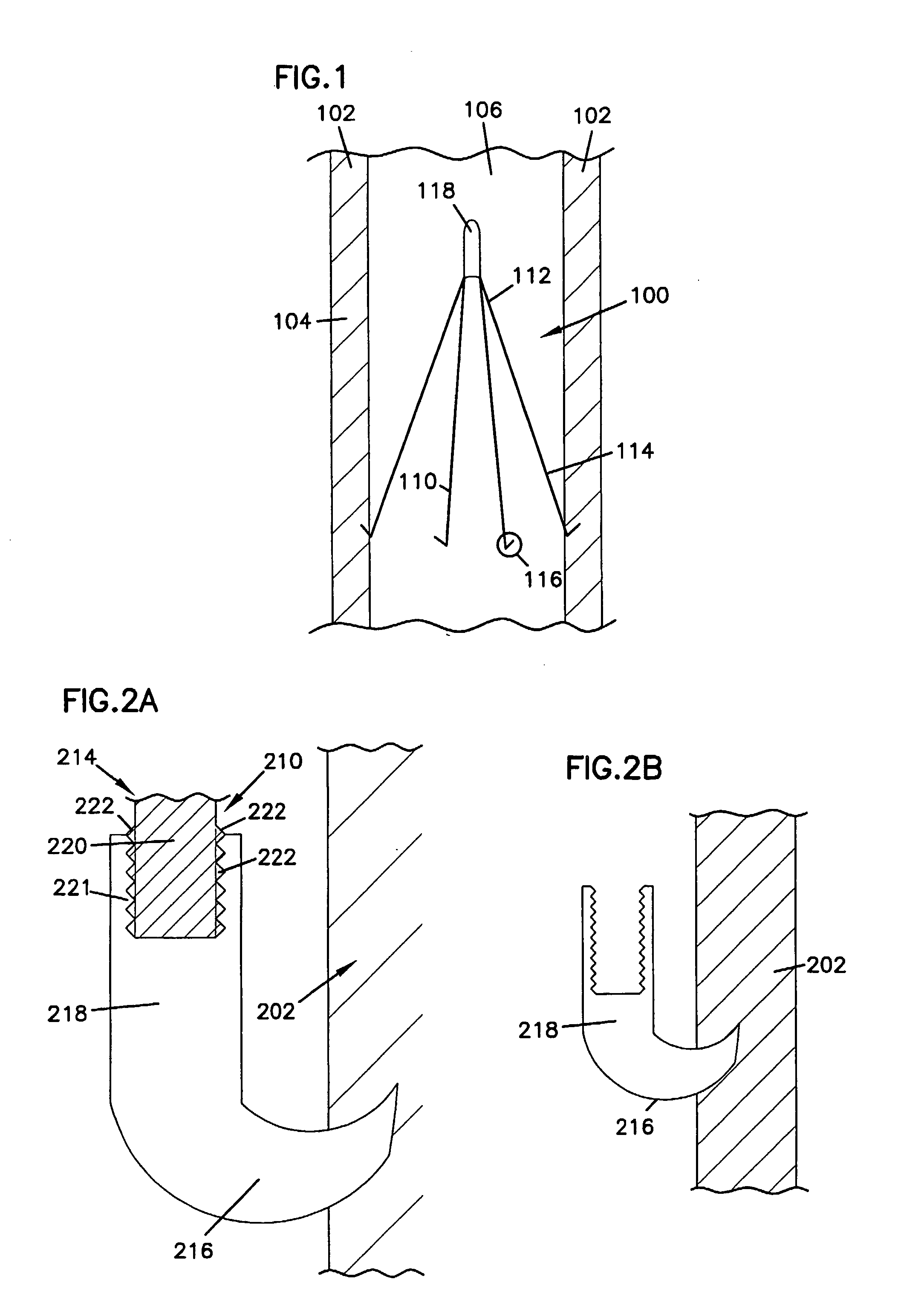 Venous Filters