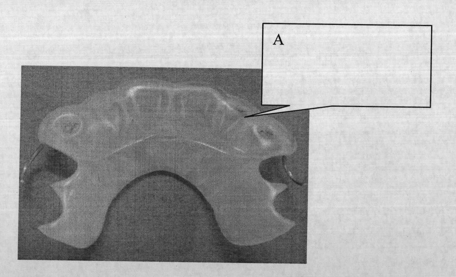 Bio-feedback instrument for bruxism