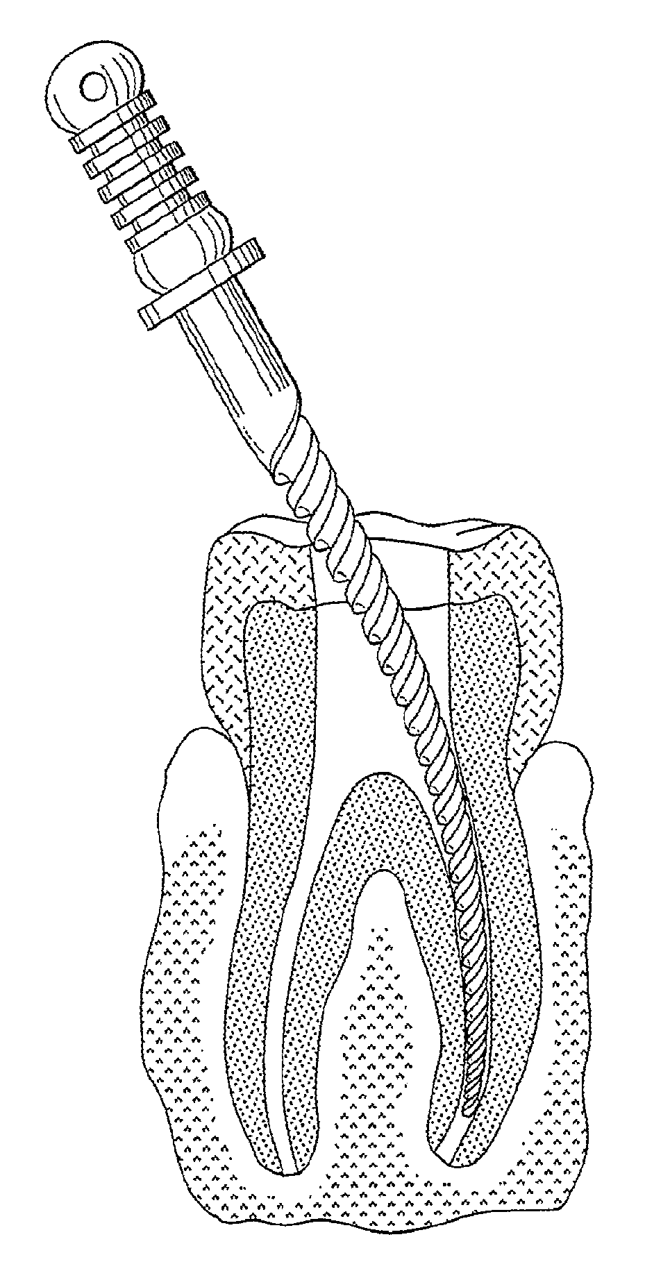 Fatigue-Resistant Nitinol Instrument