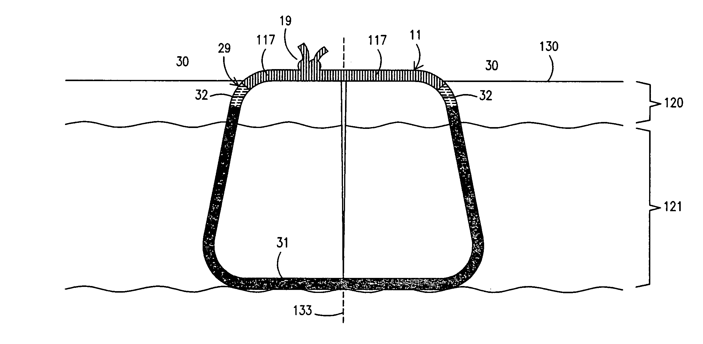 Suture treatment method and suture construction/kit therefor