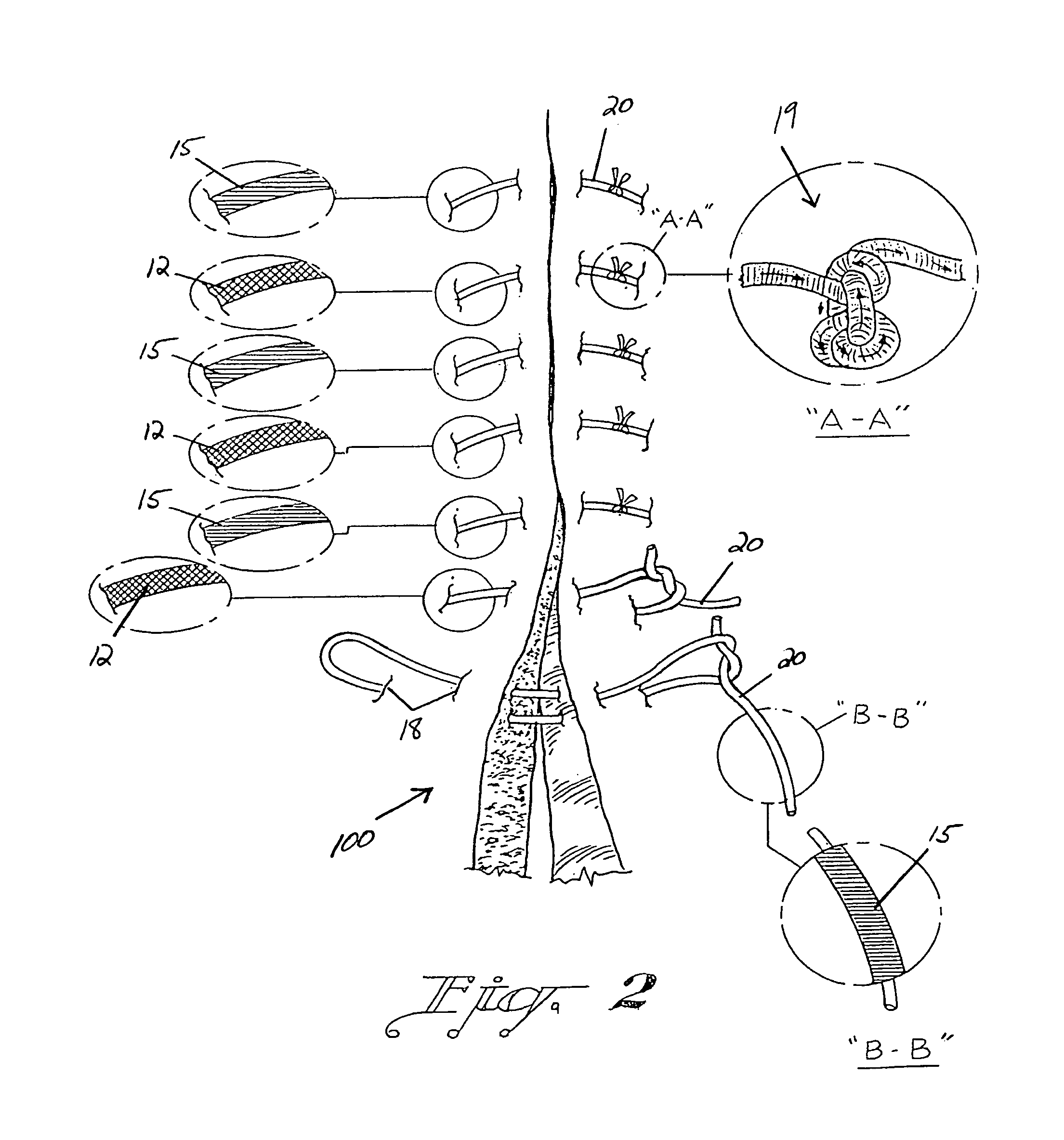 Suture treatment method and suture construction/kit therefor