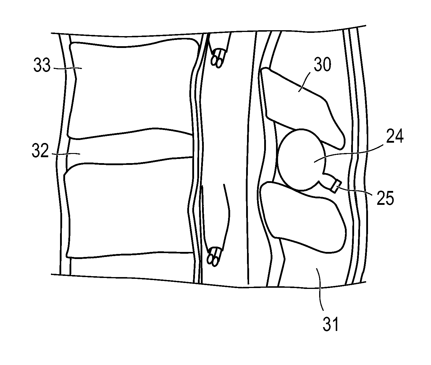 Method for dilating between spinous processes