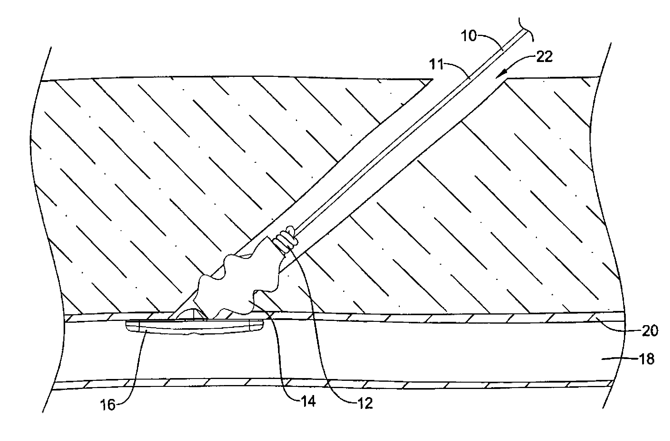 Device to detect internal bleeding