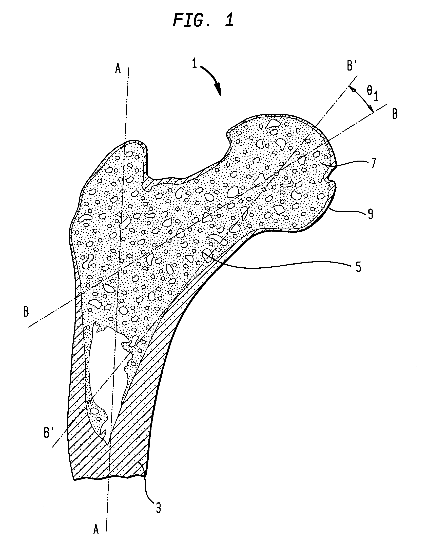 Femoral head resurfacing