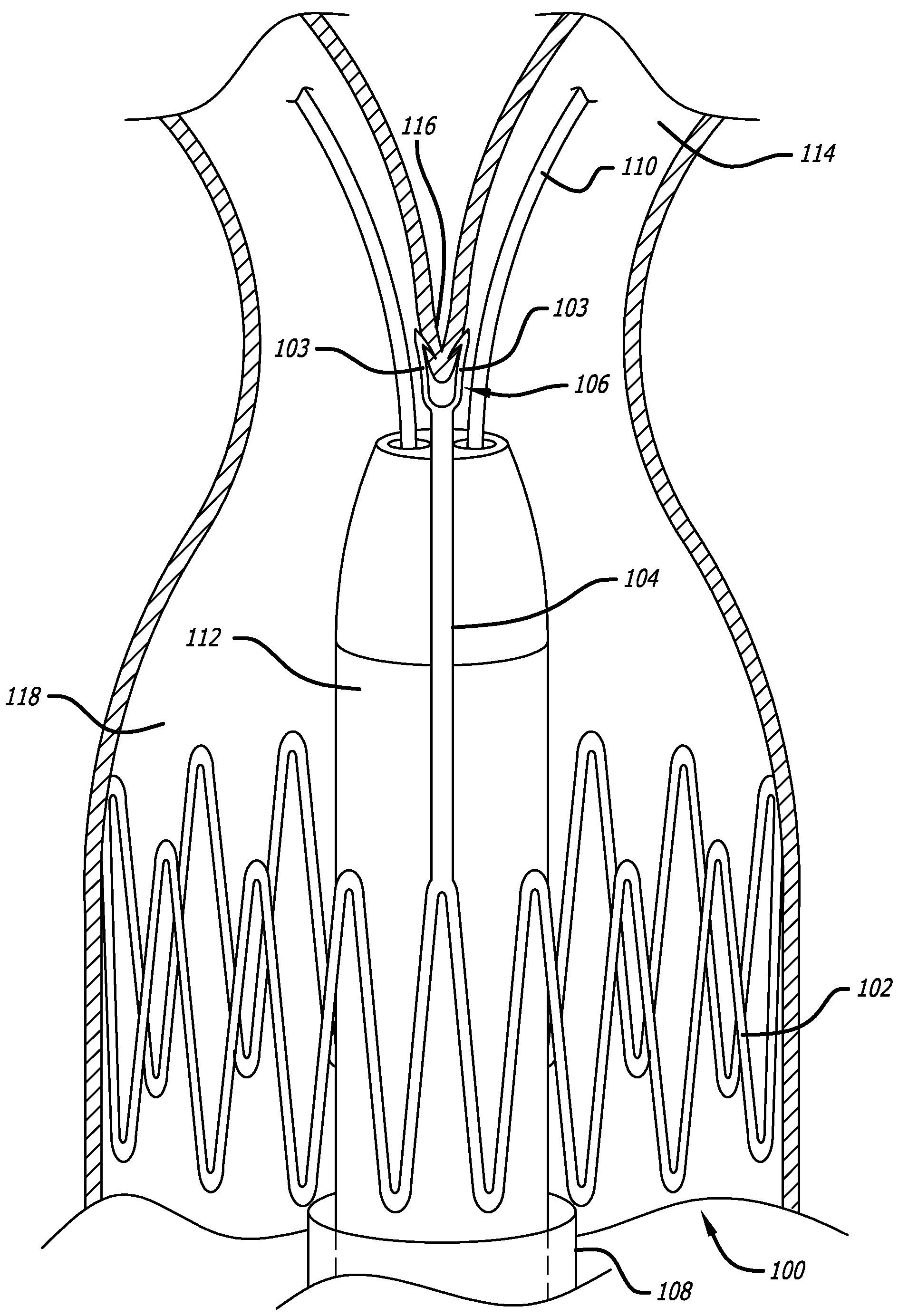 Electrical Conduction Block Implant Device