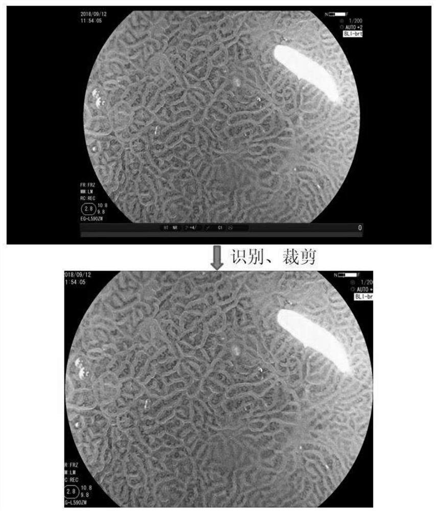 Artificial intelligence diagnosis method for gastric cancer under narrow-band imaging amplification gastroscope