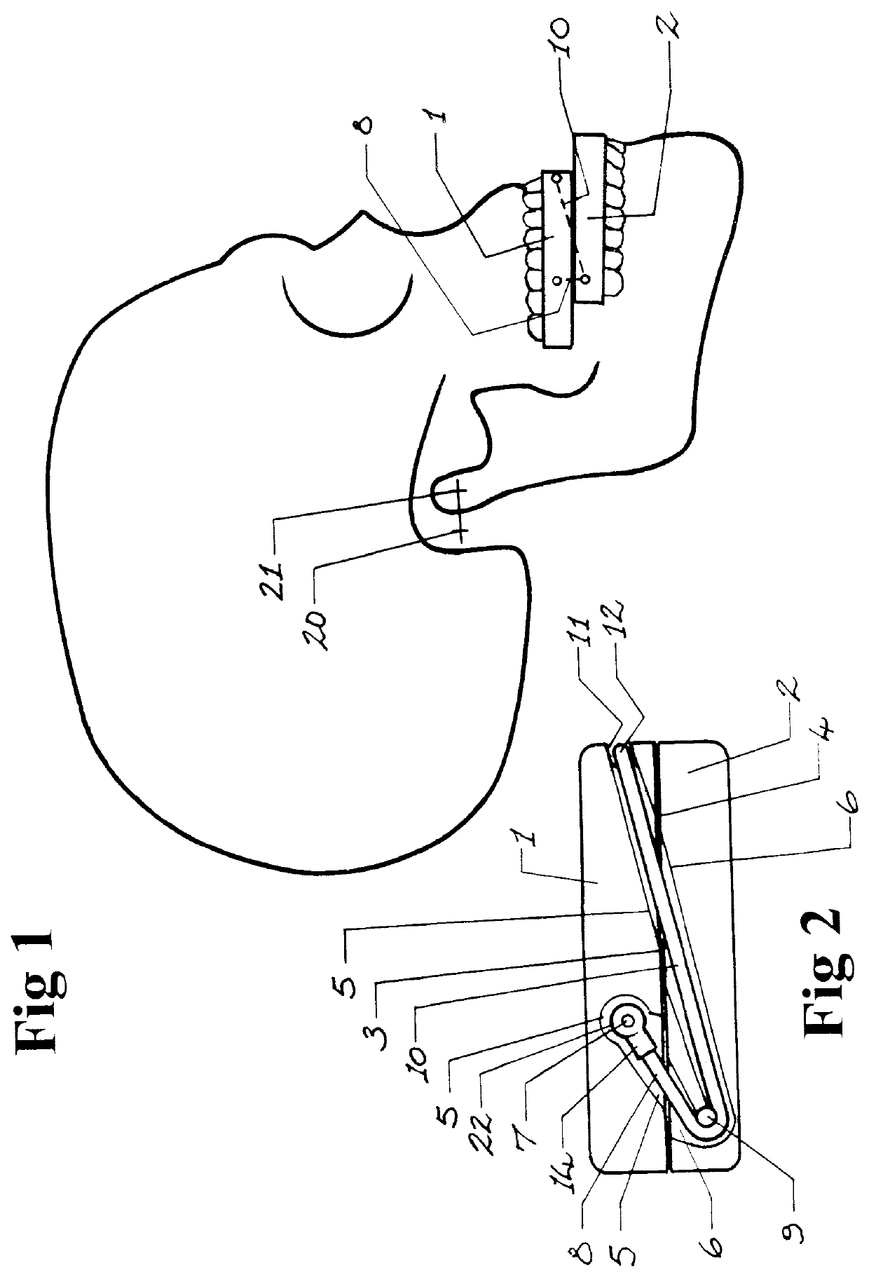 Mandibular advancement splint