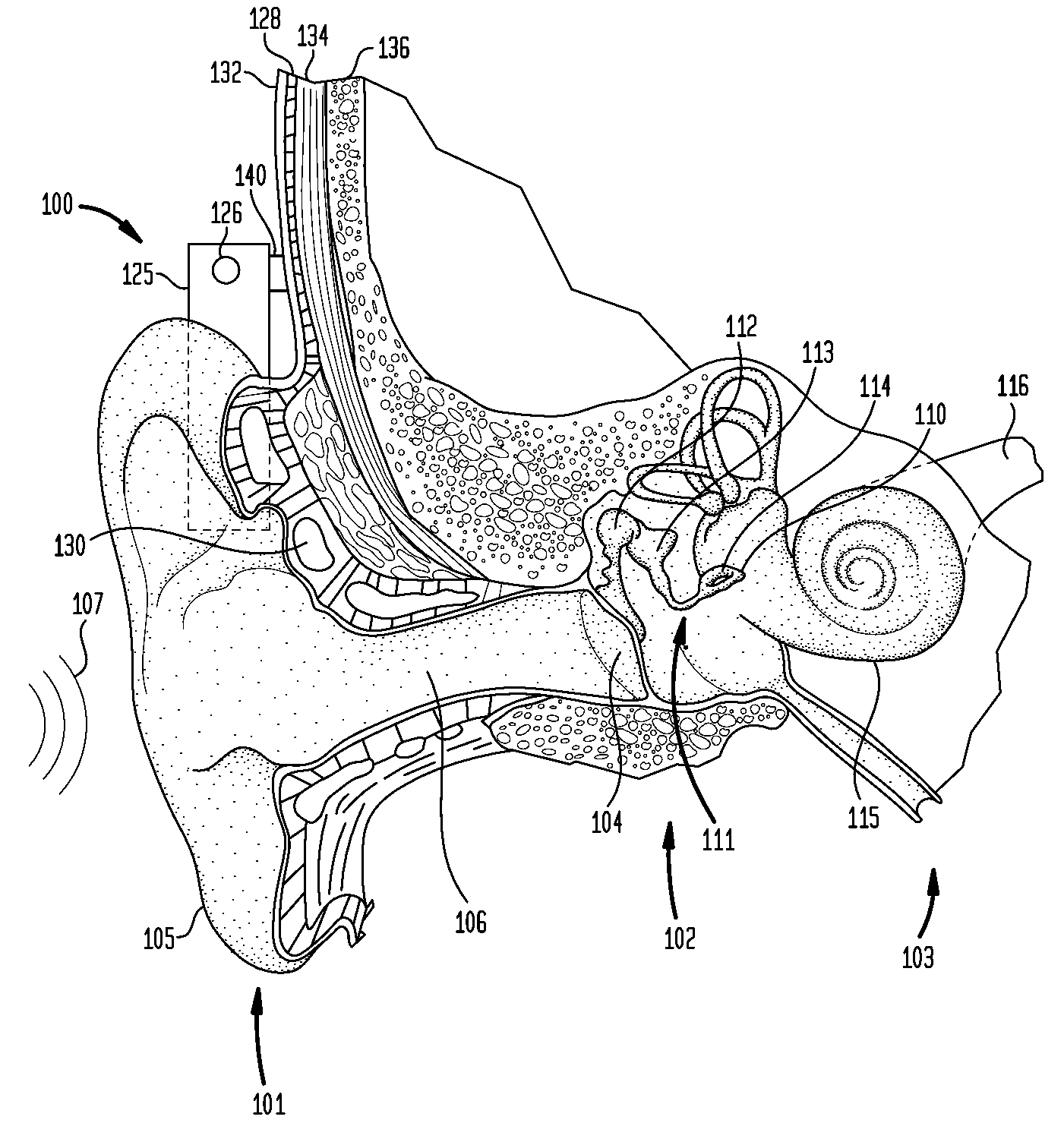 Alternative mass arrangements for bone conduction devices