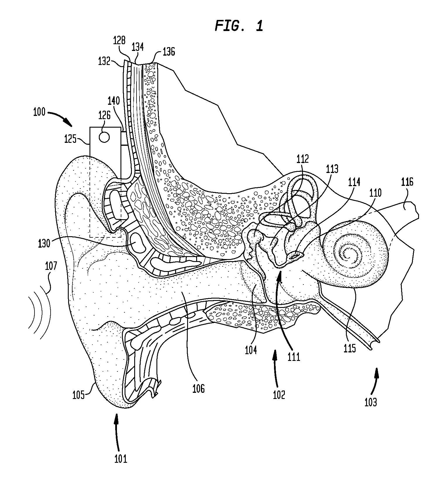 Alternative mass arrangements for bone conduction devices