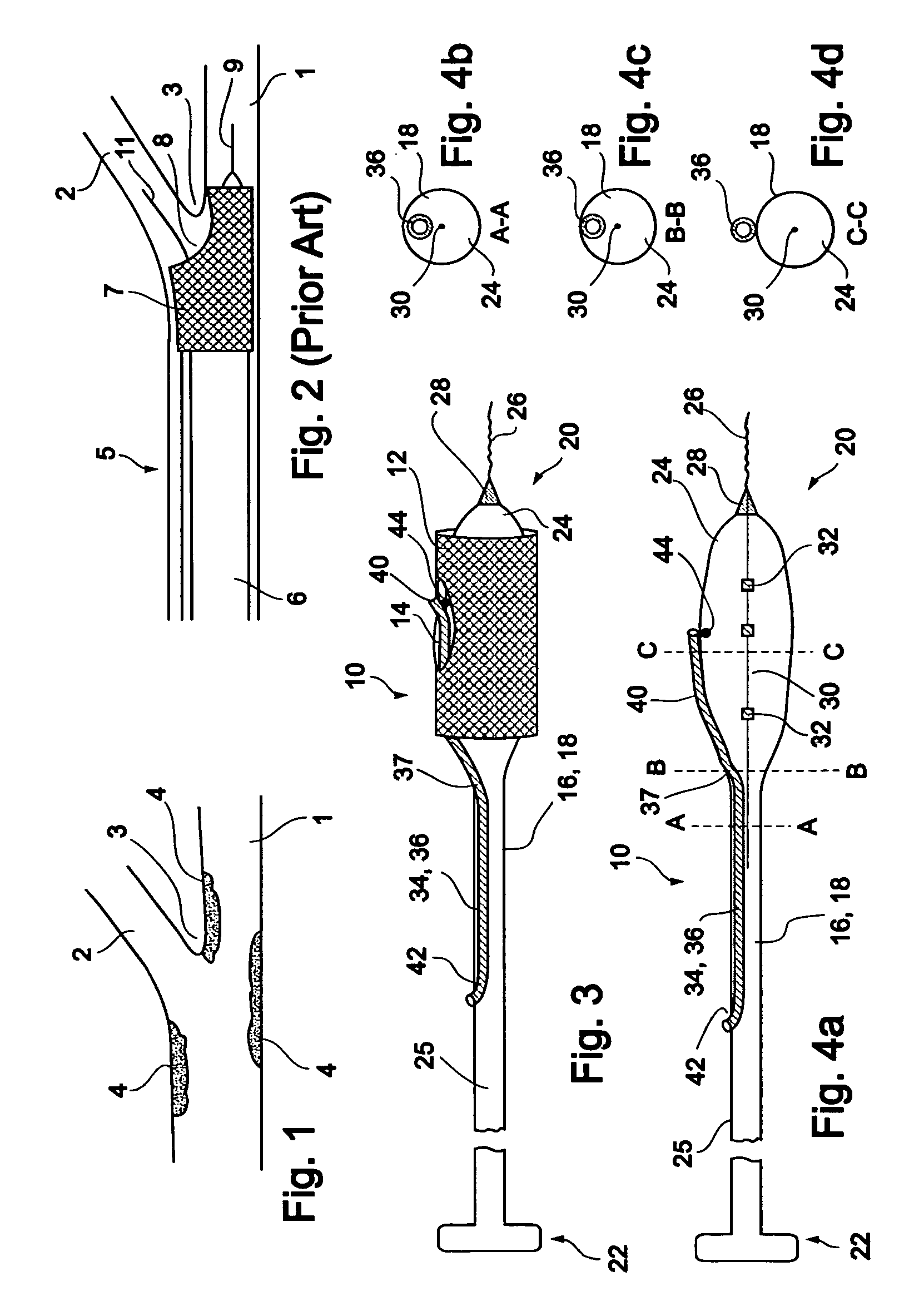 Vessel treatment devices