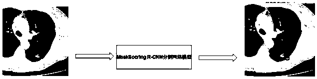 Migration learning lung lesion tissue detection system based on MaskScoring R-CNN network