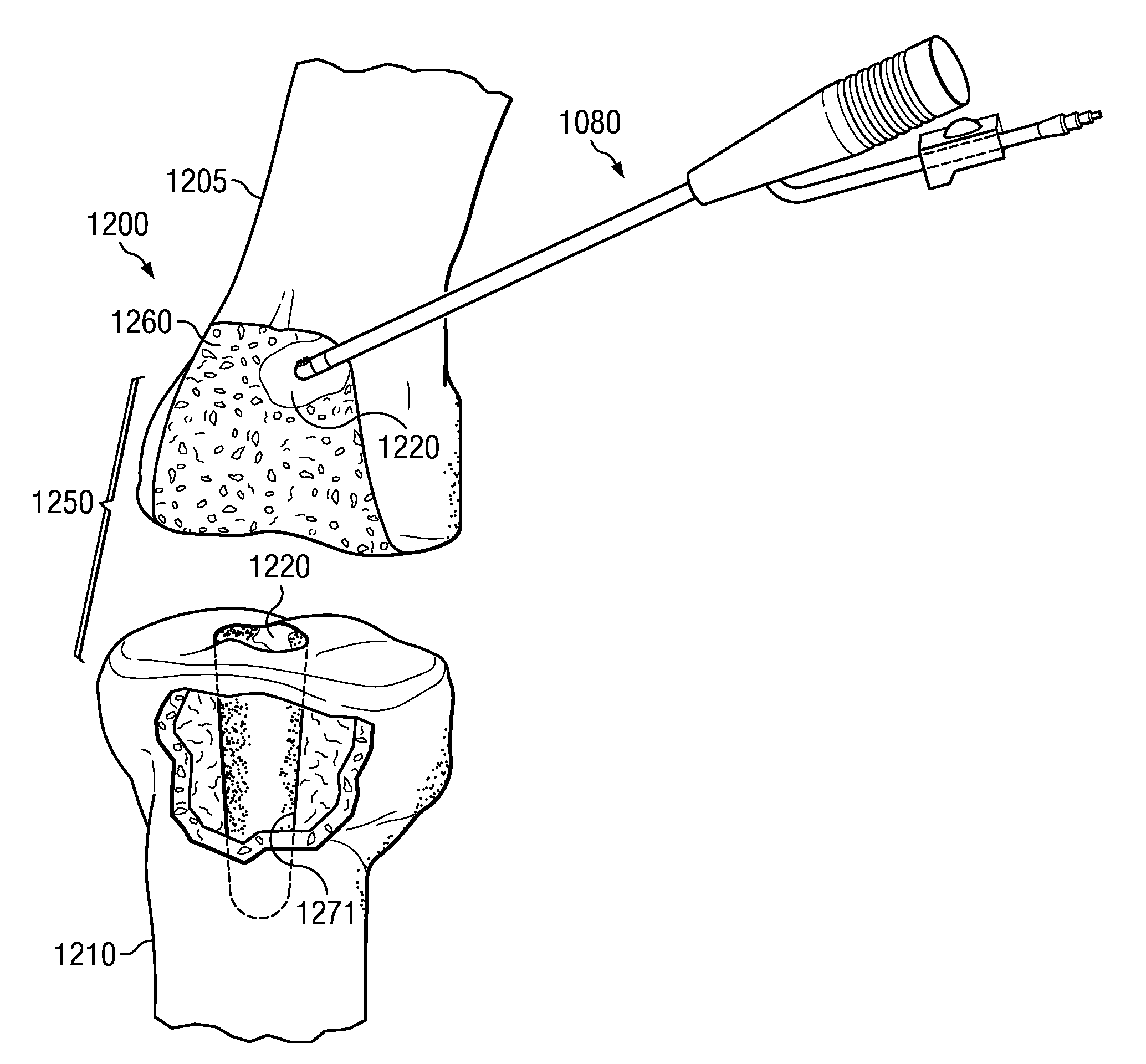 Electrosurgical system and method for treating hard body tissue