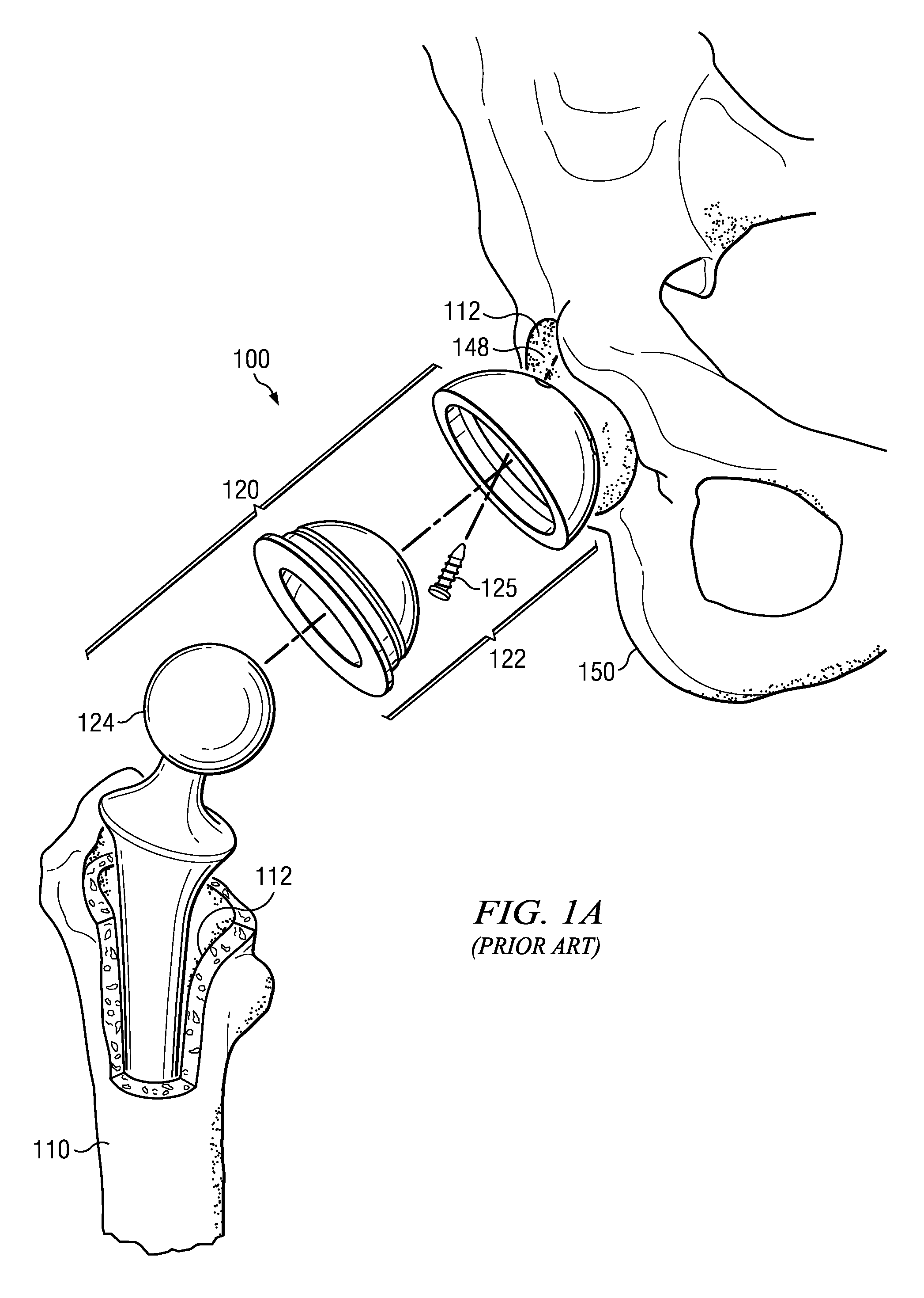 Electrosurgical system and method for treating hard body tissue