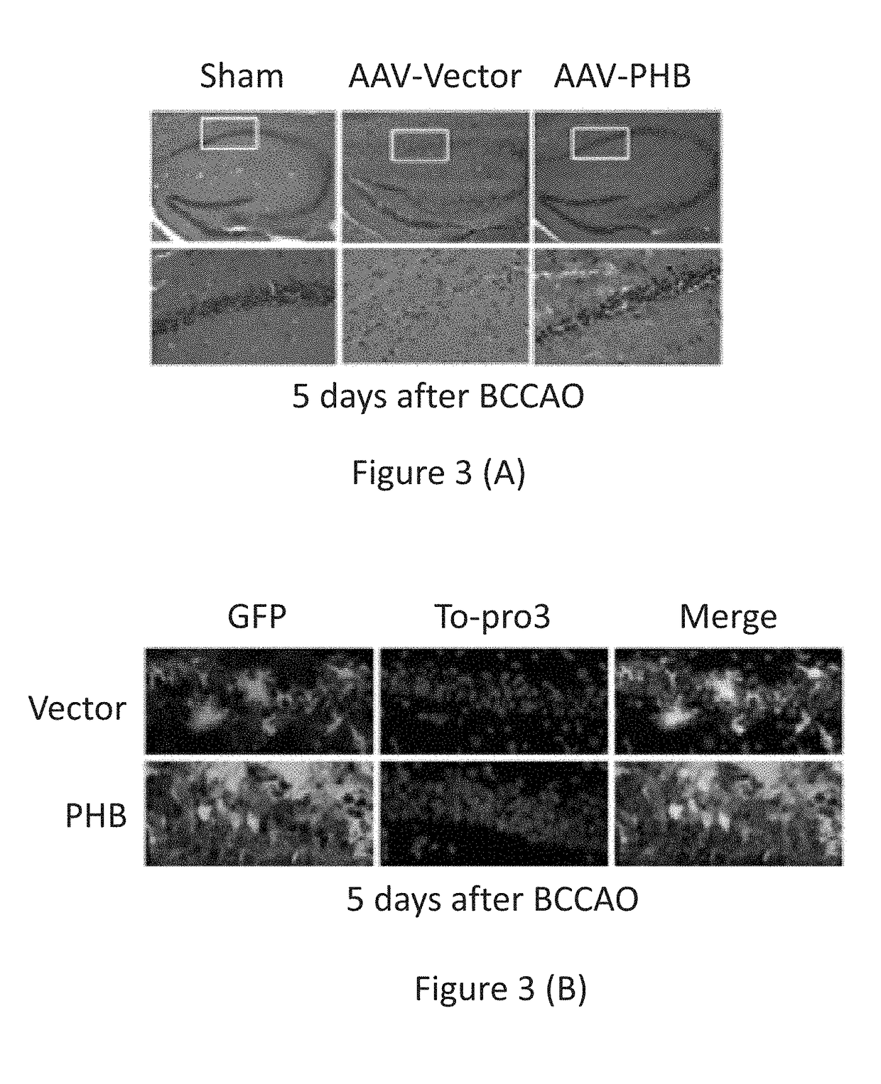 Gene therapy for Alzheimer's and other neurodegenerative diseases and conditions