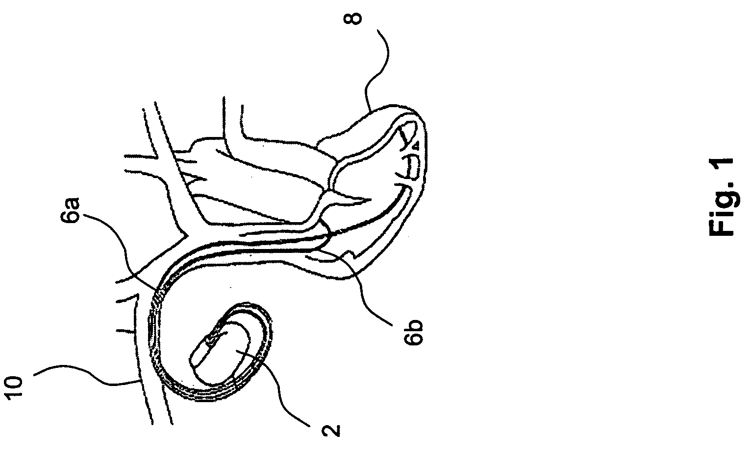 Method and implantable device for measuring hematocrit