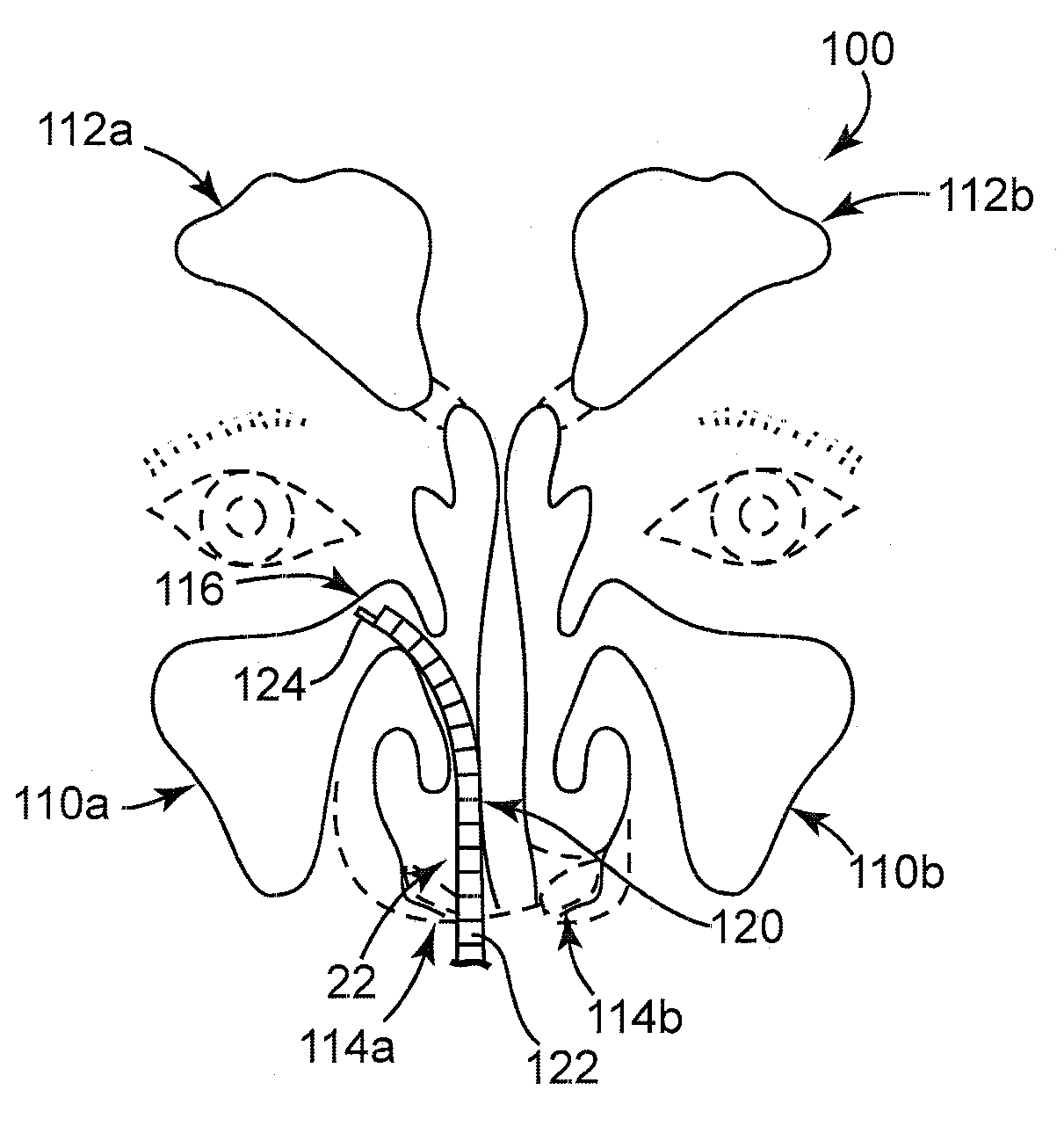 Solvating system and sealant for medical use in the sinuses and nasal passages