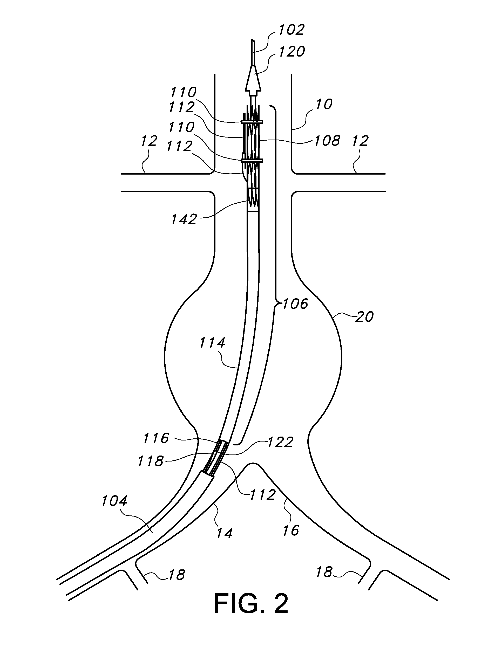 Endovascular delivery system with flexible and torqueable hypotube