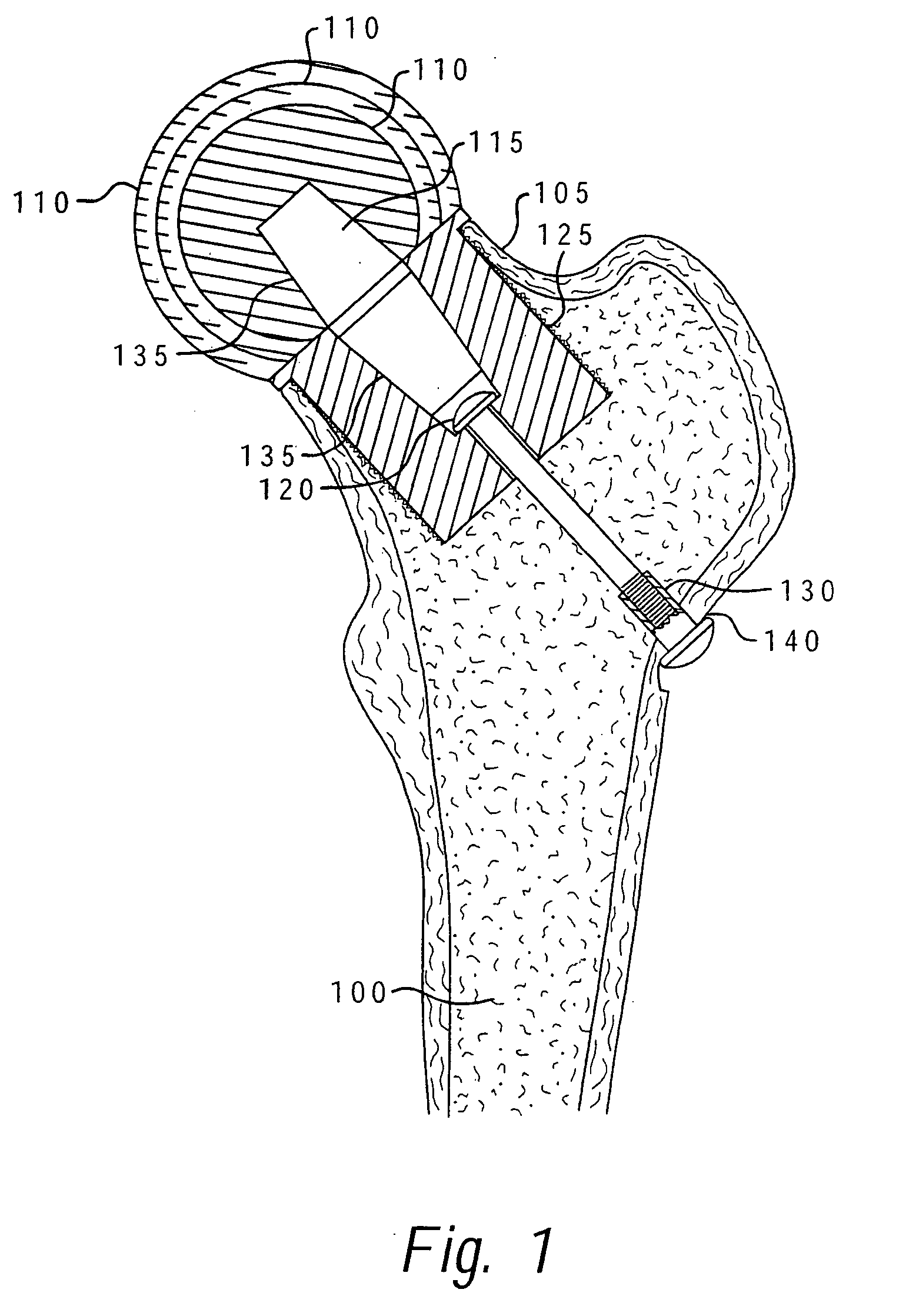 Method of implanting a femoral neck fixation prosthesis