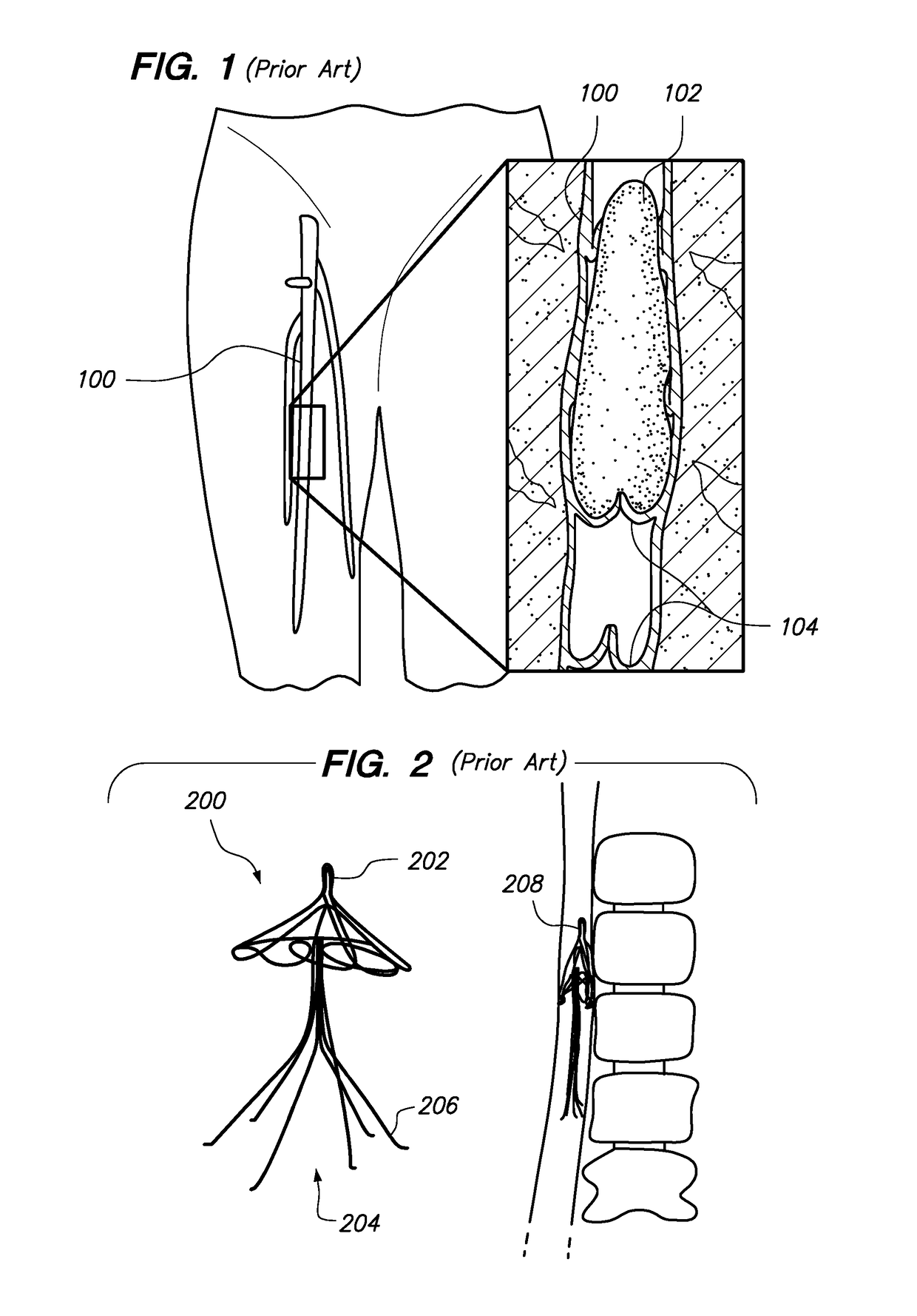 Intravenous Filter with Guidewire and Catheter Access Guide