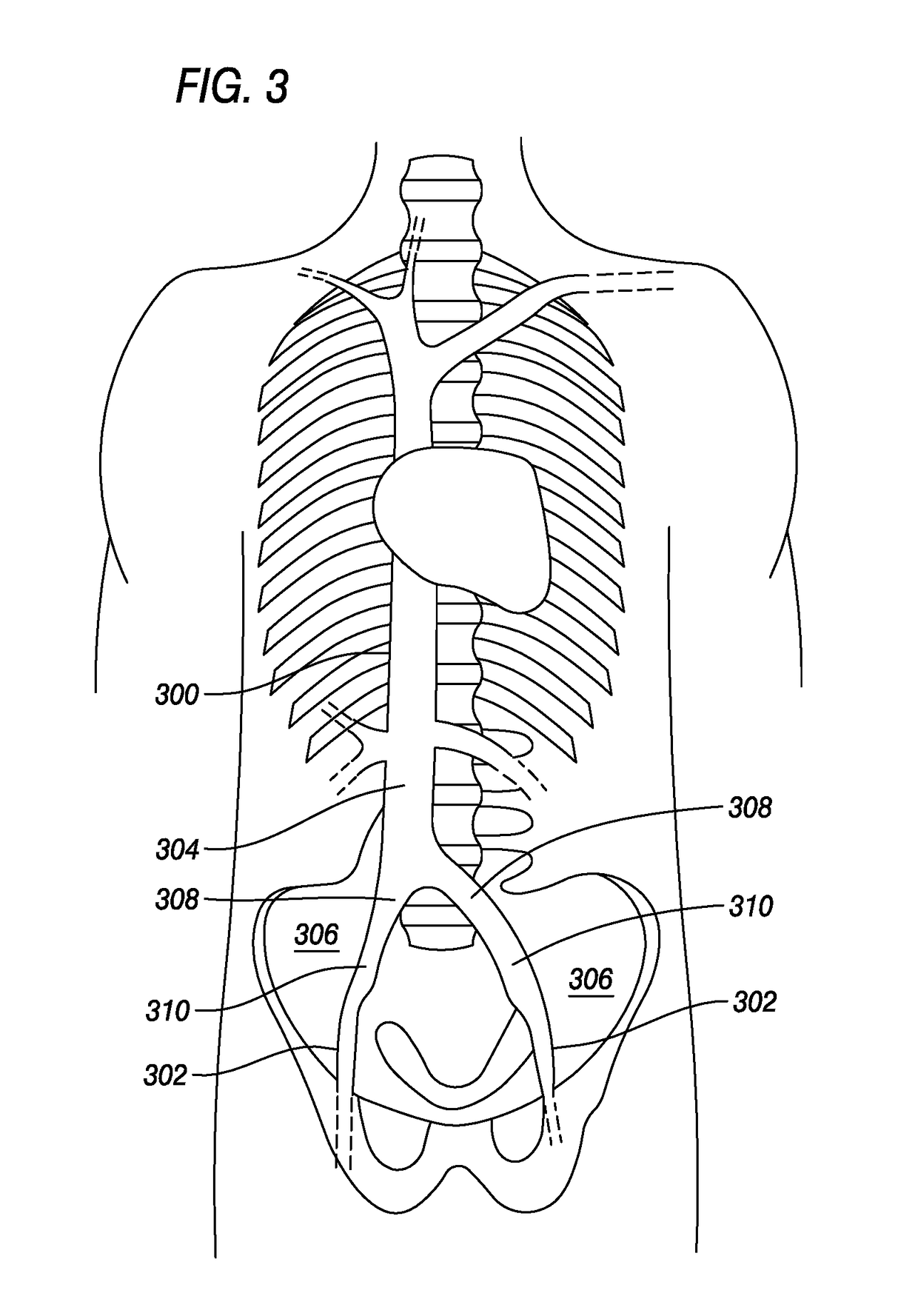 Intravenous Filter with Guidewire and Catheter Access Guide